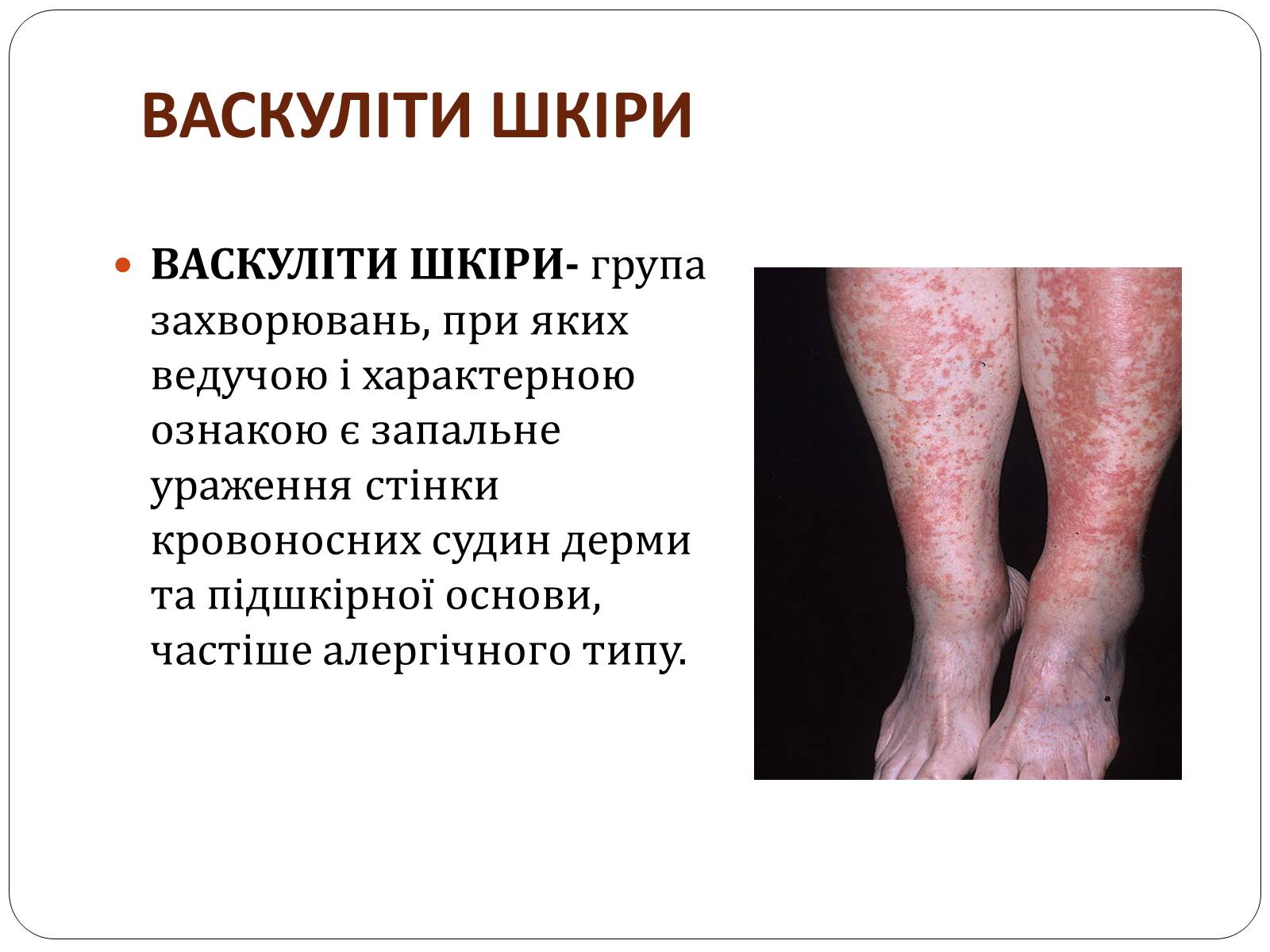Презентація на тему «Захворювання шкіри» (варіант 3) - Слайд #11