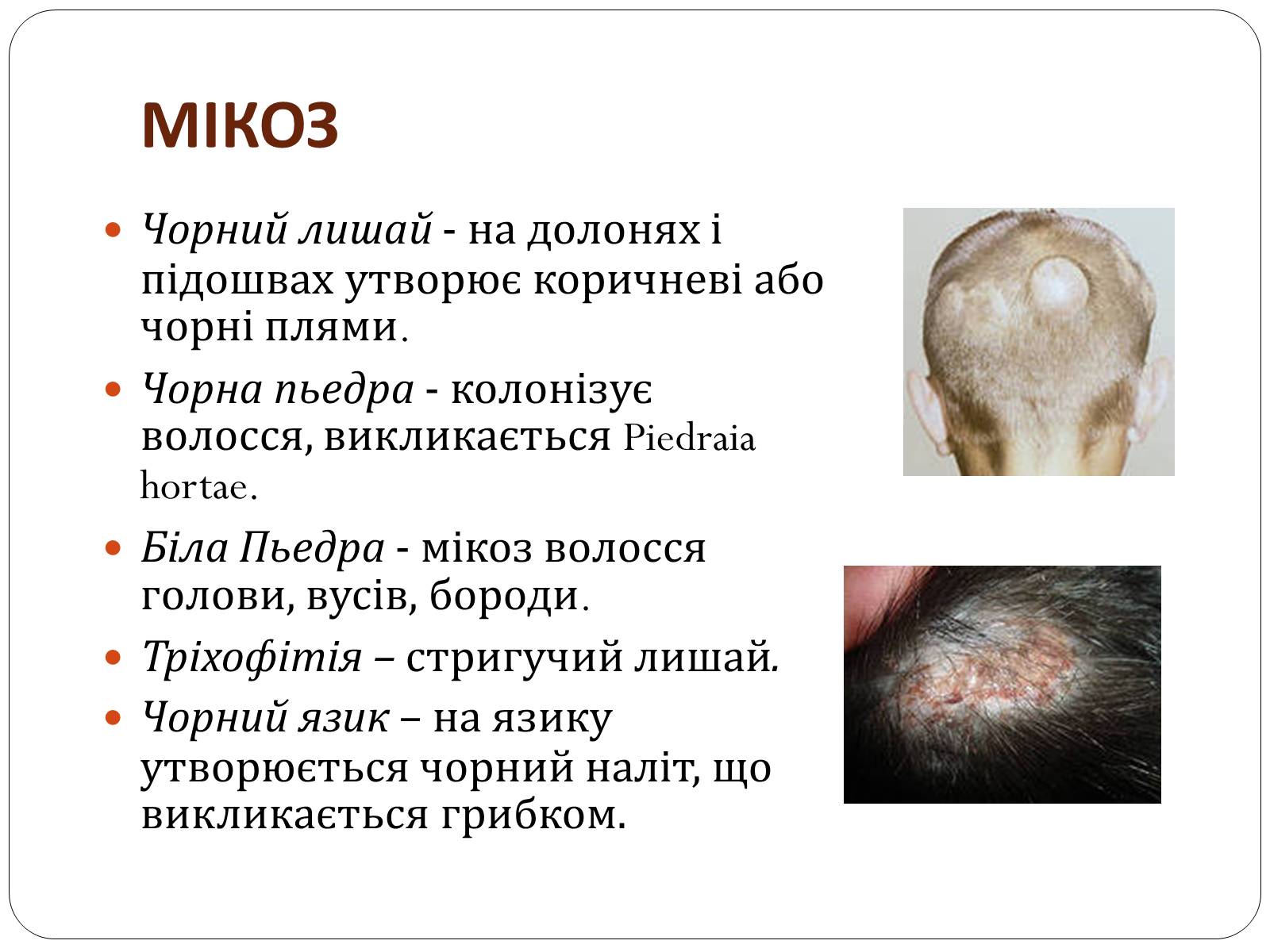 Презентація на тему «Захворювання шкіри» (варіант 3) - Слайд #15