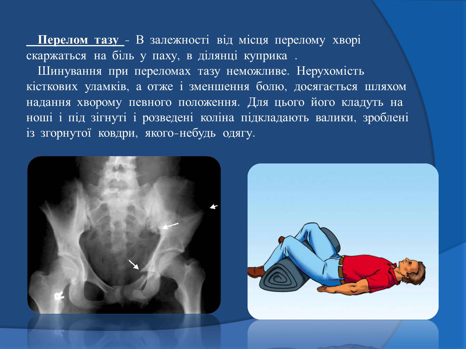 Презентація на тему «Травми кісток та суглобів» - Слайд #13