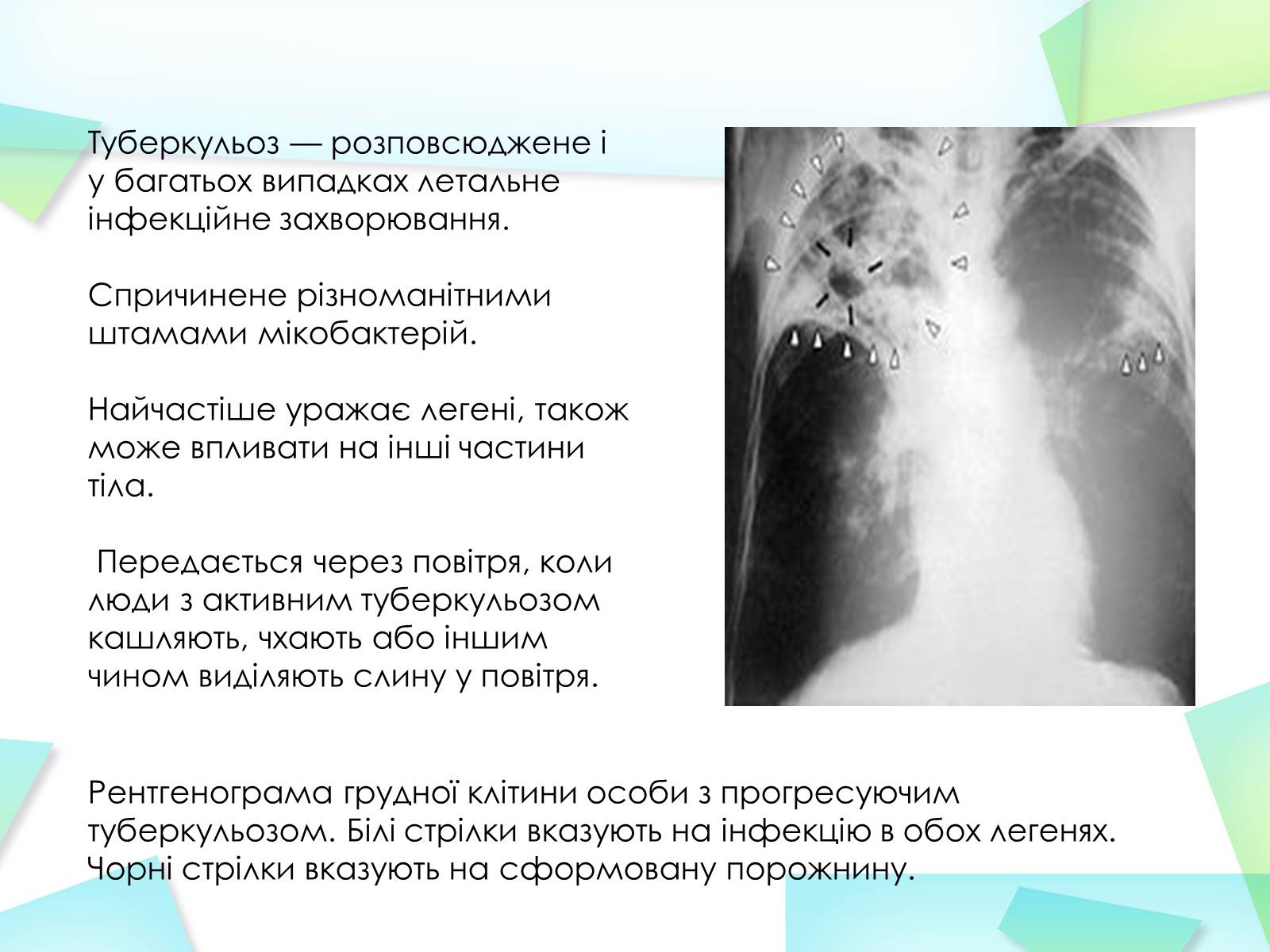 Презентація на тему «Туберкулез» (варіант 3) - Слайд #2