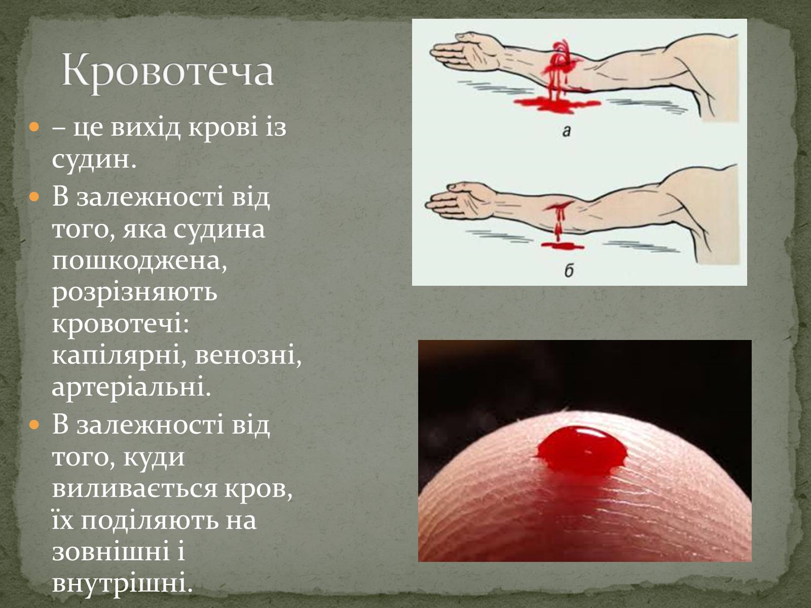 Презентація на тему «Види кровотеч» (варіант 1) - Слайд #2