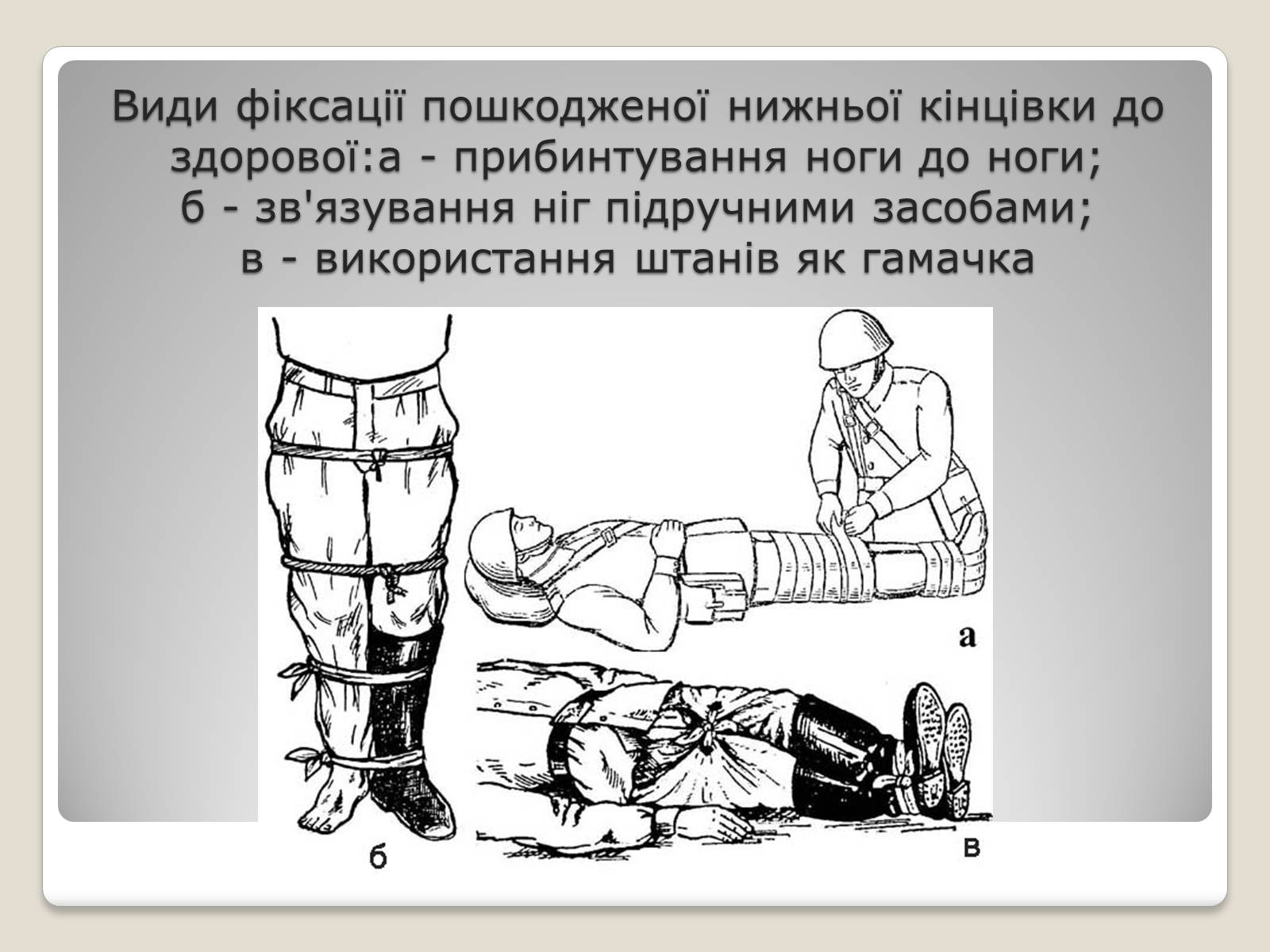 Презентація на тему «Іммобілізація ушкодженої ділянки тіла» - Слайд #6