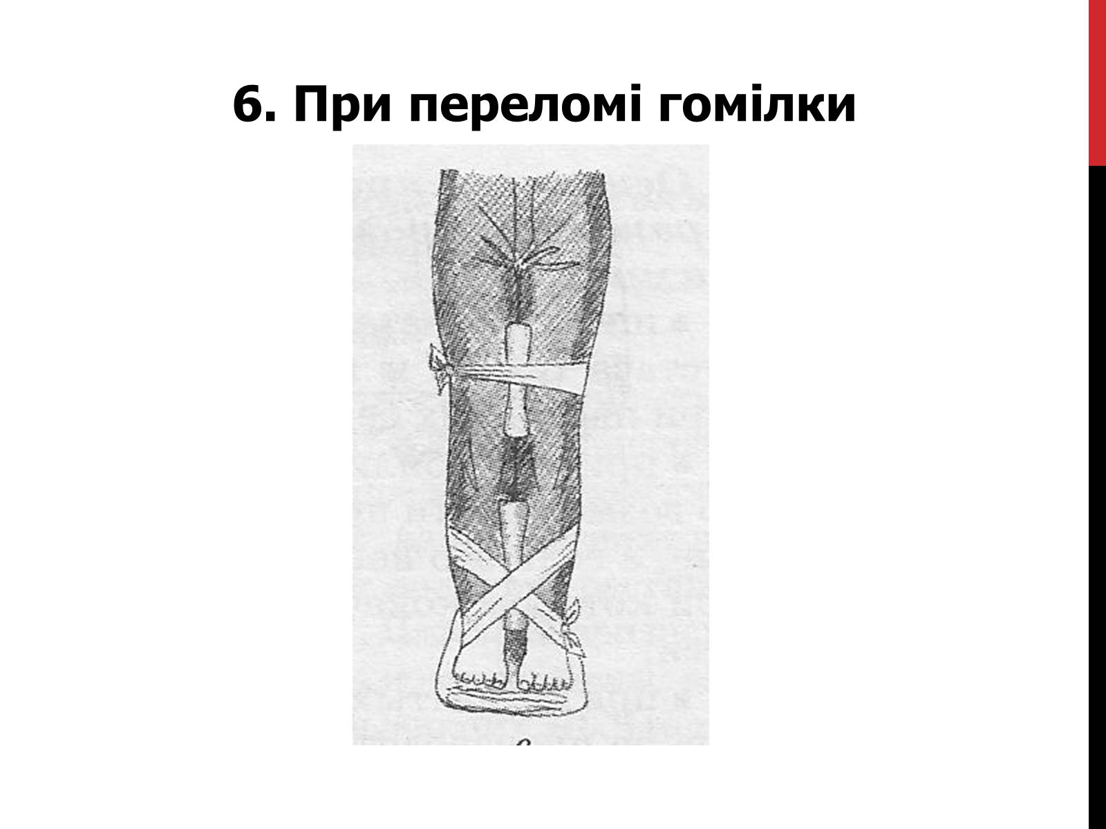 Презентація на тему «Іммобілізація верхніх та нижніх кінцівок» - Слайд #12