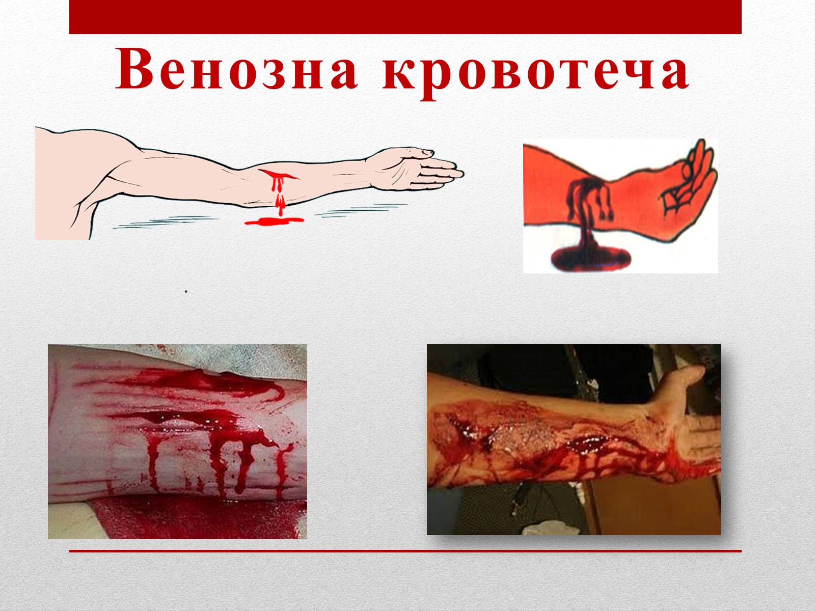 Презентація на тему «Кровотечі» (варіант 2) - Слайд #7