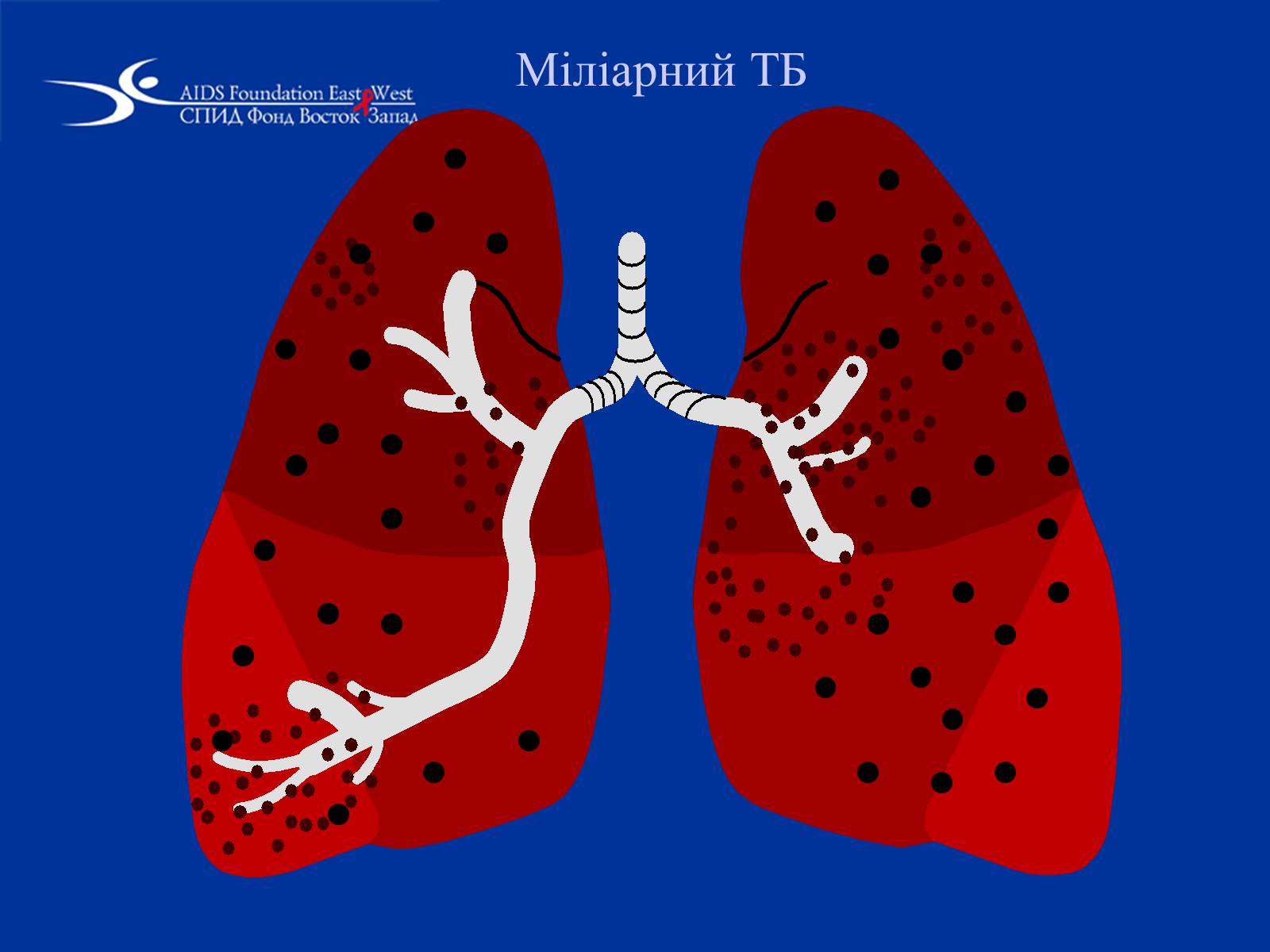 Презентація на тему «Туберкульоз» (варіант 1) - Слайд #24