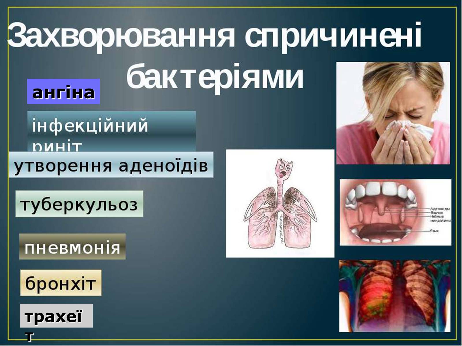 Презентація на тему «Захворювання дихальної системи» (варіант 2) - Слайд #6