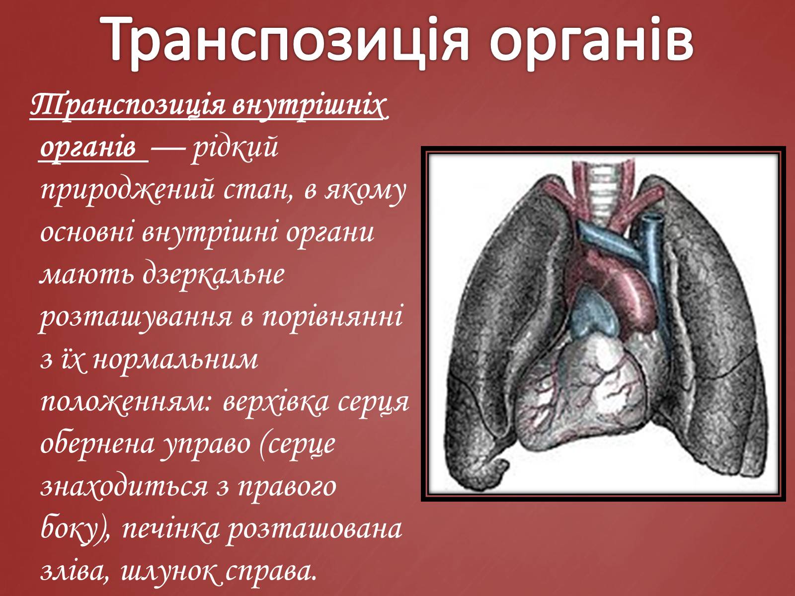 Презентація на тему «Захворювання серцево-судинної системи» (варіант 2) - Слайд #6
