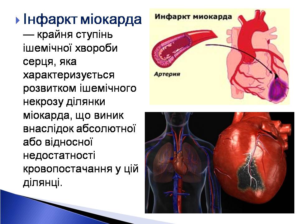 Презентація на тему «Інфаркт міокарда» (варіант 2) - Слайд #2