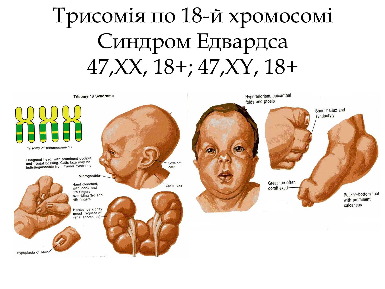 Презентація на тему «Хромосомні хвороби» (варіант 1) - Слайд #5