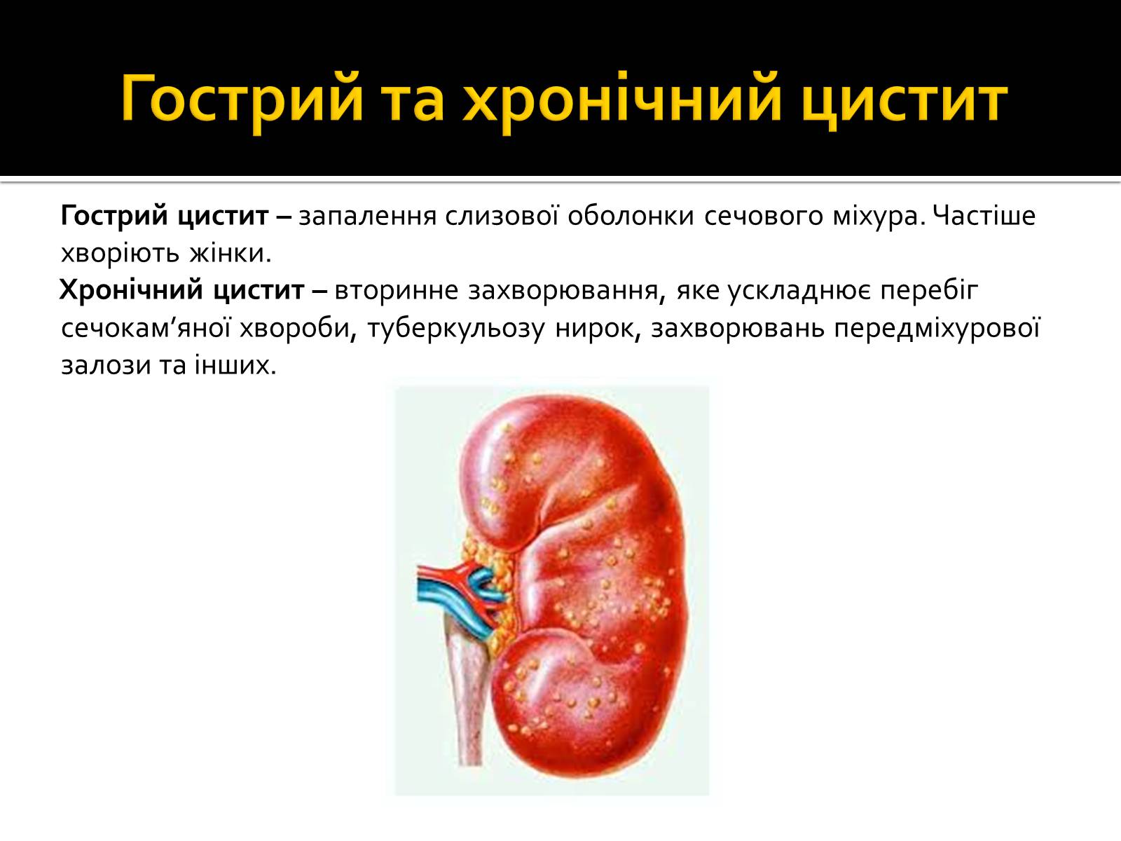 Презентація на тему «Захворювання нирок та сечовивідних шляхів» - Слайд #10