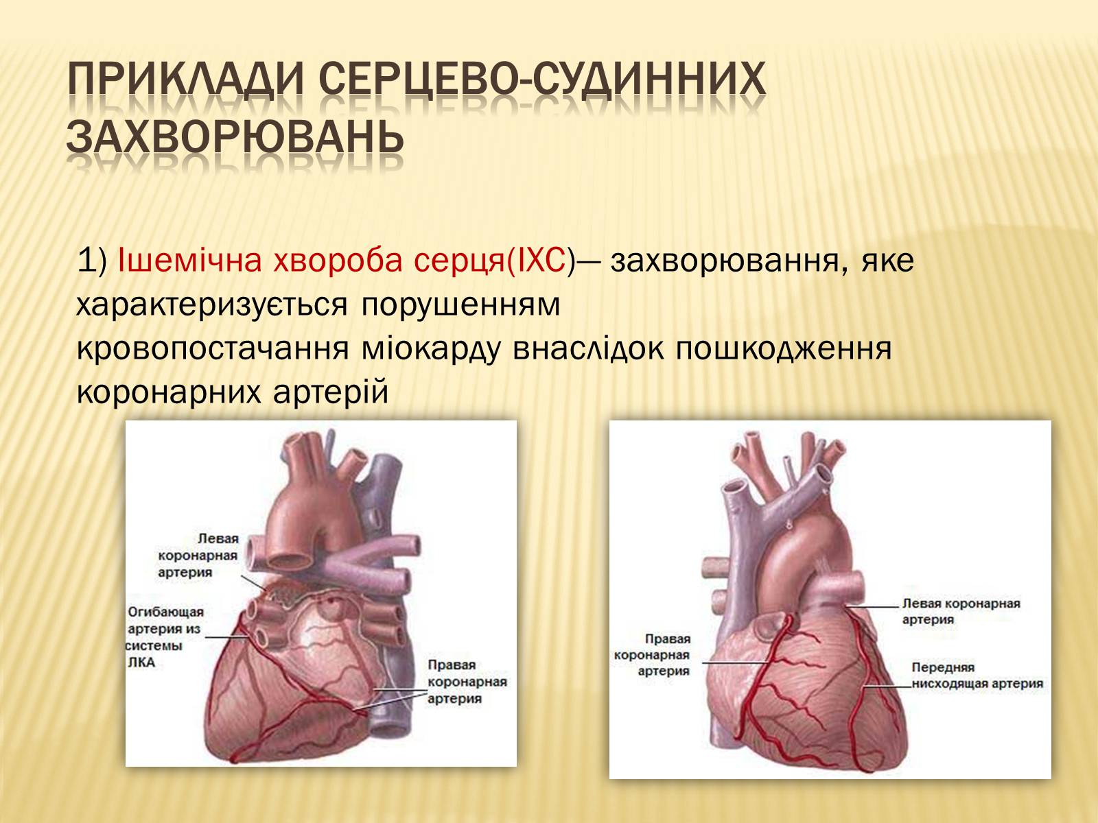 Презентація на тему «Захворювання серцево-судинної системи» (варіант 3) - Слайд #4