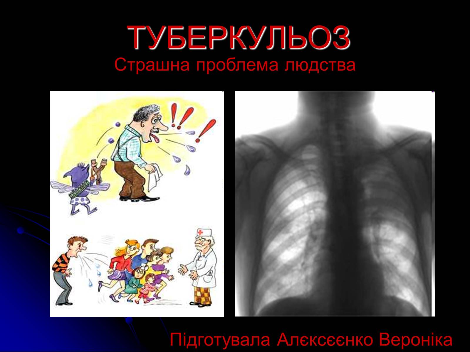 Презентація на тему «Туберкульоз» (варіант 4) - Слайд #1