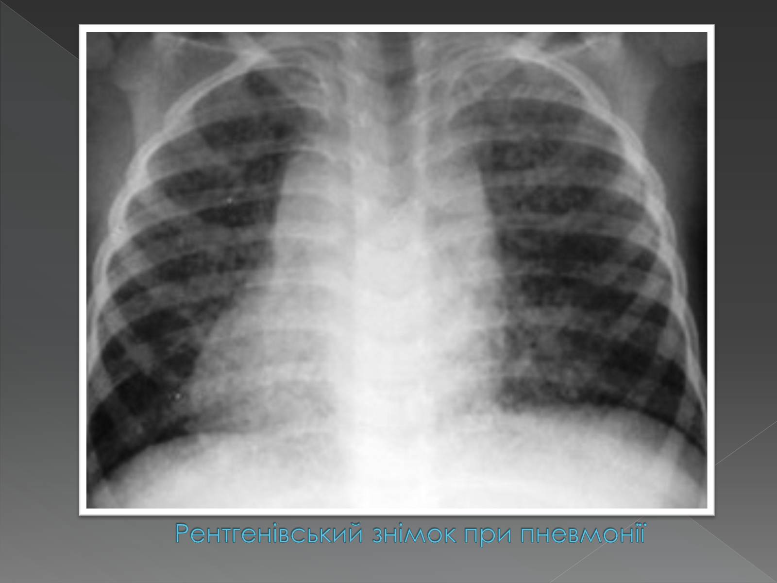 Презентація на тему «Види професійних захворювань органів дихання» - Слайд #12