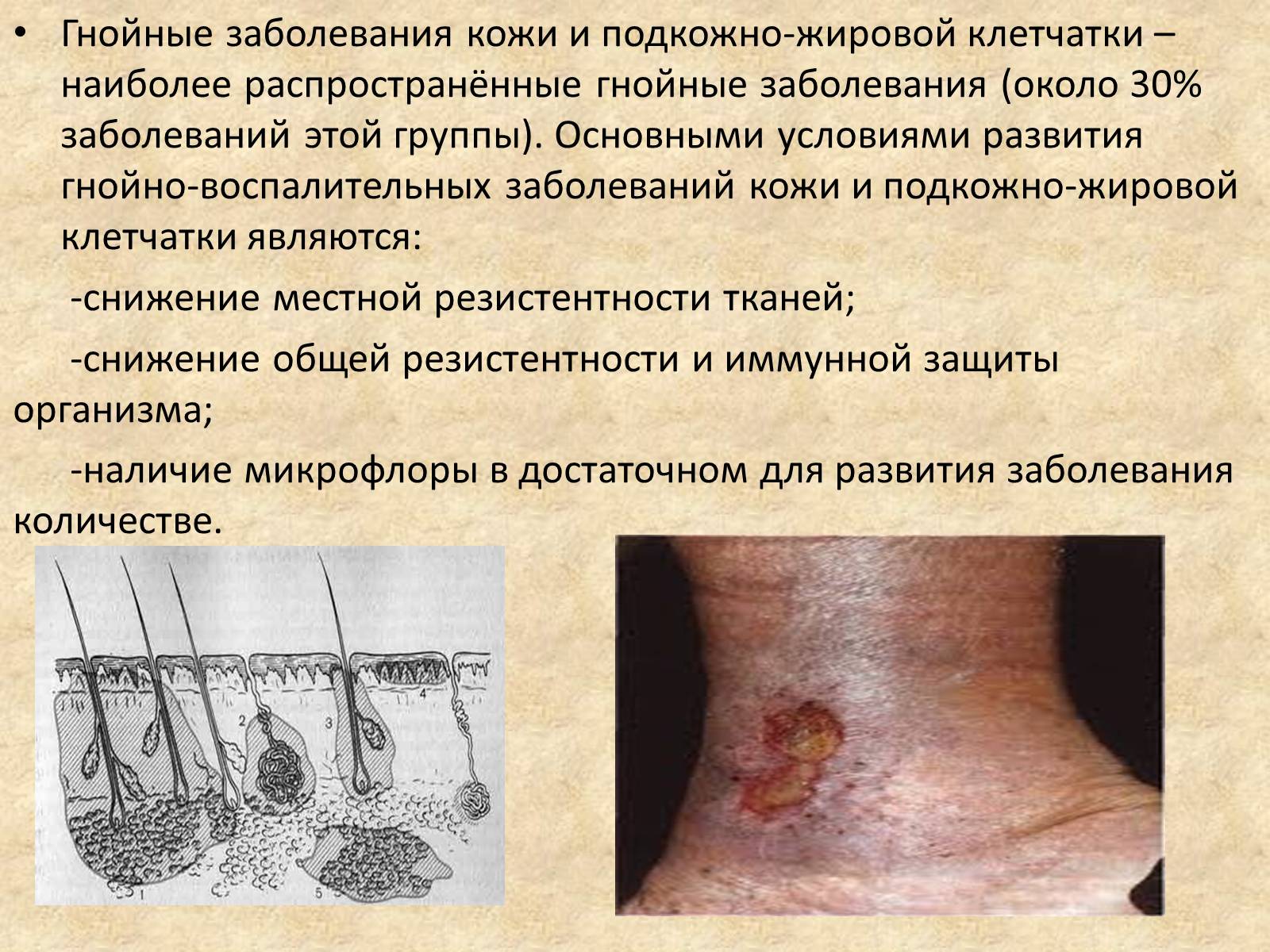 Презентація на тему «Гнойные заболевания кожи и подкожной клетчатки» - Слайд #2