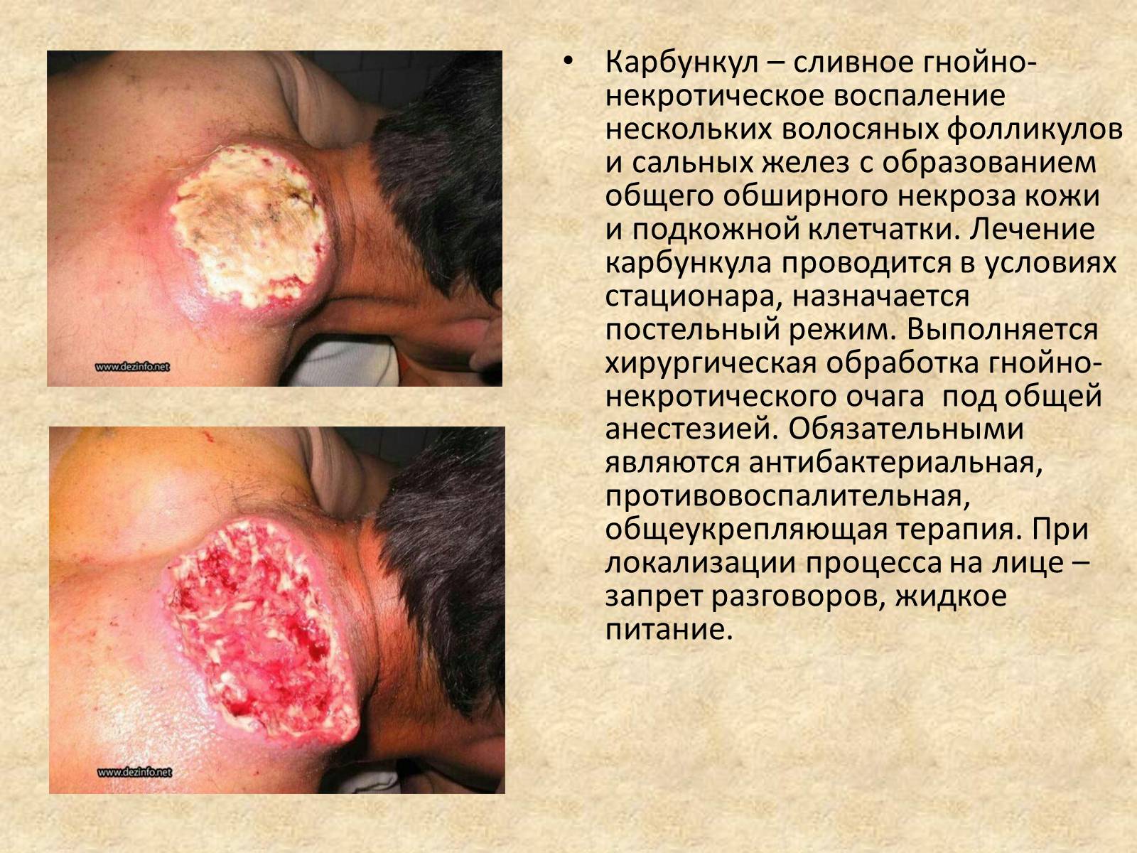 Презентація на тему «Гнойные заболевания кожи и подкожной клетчатки» - Слайд #5