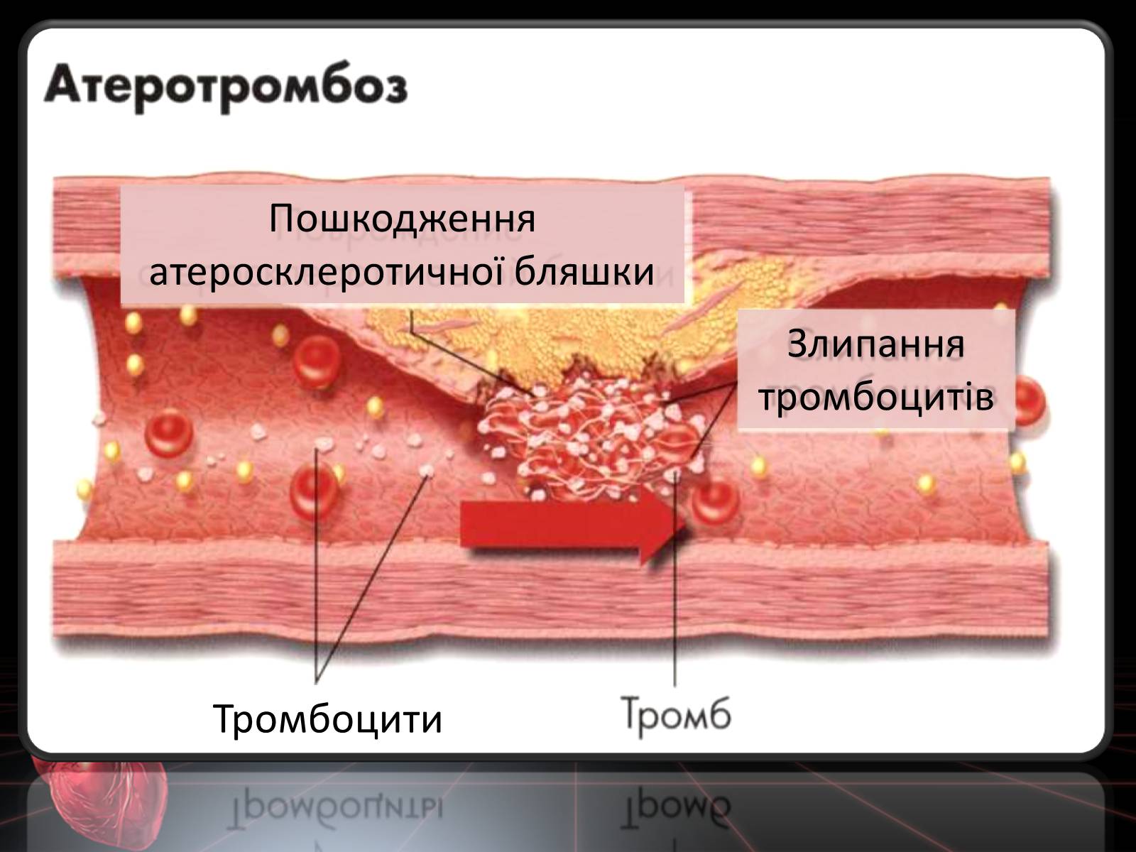 Презентація на тему «Методи відновлення кровообігу в уражених атеросклерозом коронарних артеріях при ішемічній хворобі серця» - Слайд #8