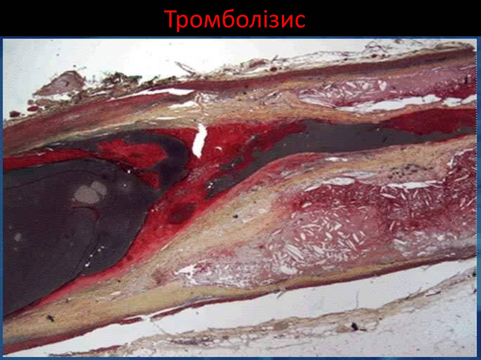 Презентація на тему «Методи відновлення кровообігу в уражених атеросклерозом коронарних артеріях при ішемічній хворобі серця» - Слайд #16