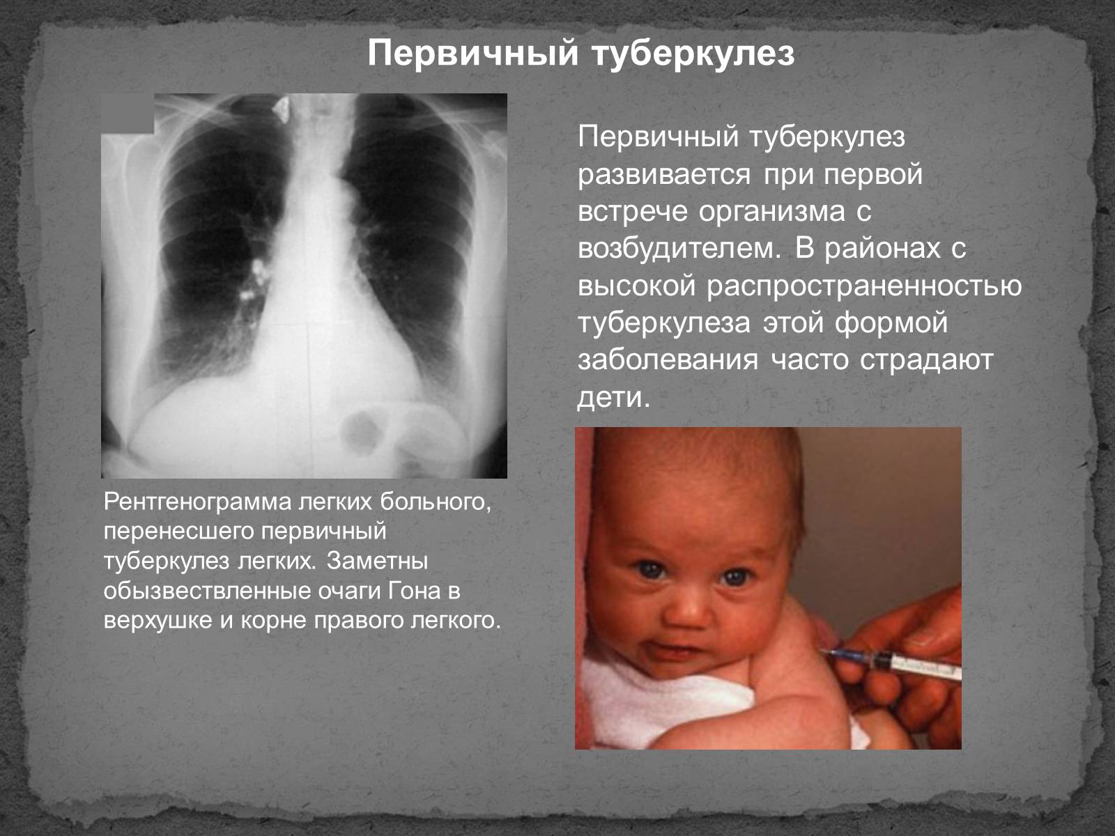Презентація на тему «Туберкулез» (варіант 1) - Слайд #5