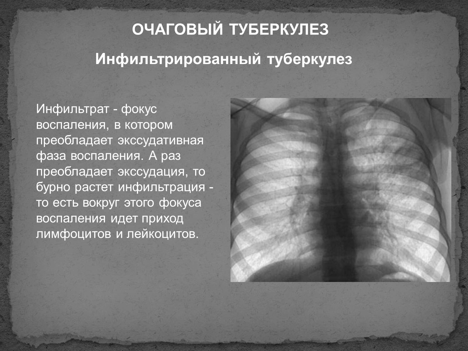 Презентація на тему «Туберкулез» (варіант 1) - Слайд #8