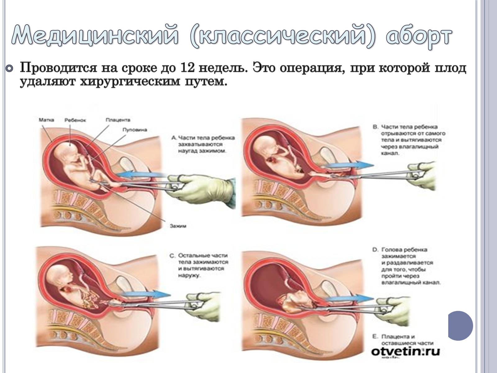 Презентація на тему «Аборт» - Слайд #8