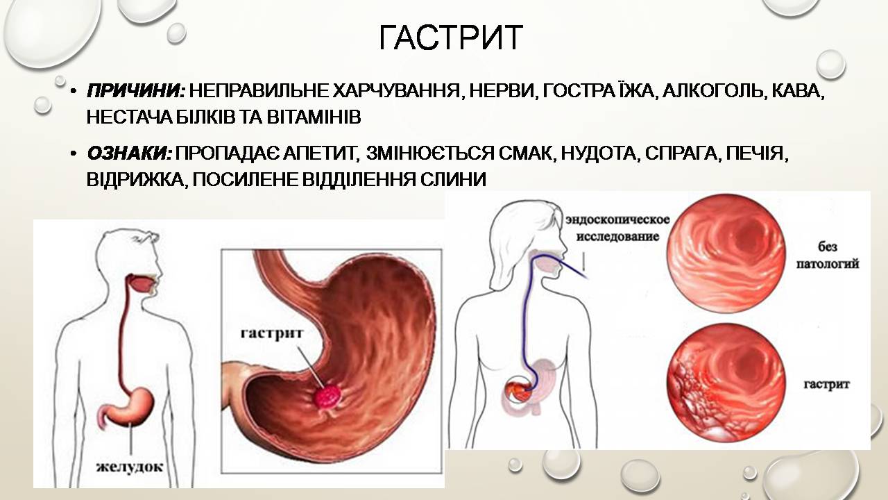 Презентація на тему «Перша допомога при захворюваннях шлунково-кишкового тракту та сечовивідної системи» - Слайд #7