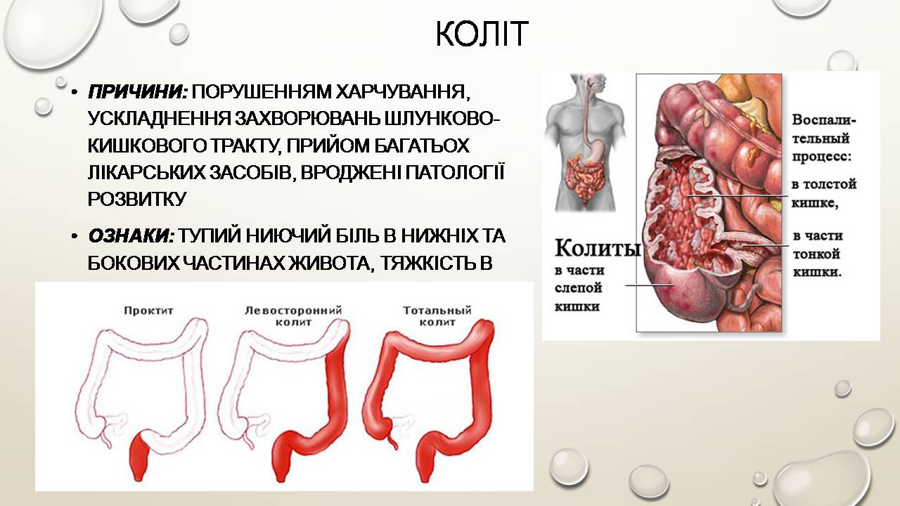Презентація на тему «Перша допомога при захворюваннях шлунково-кишкового тракту та сечовивідної системи» - Слайд #8