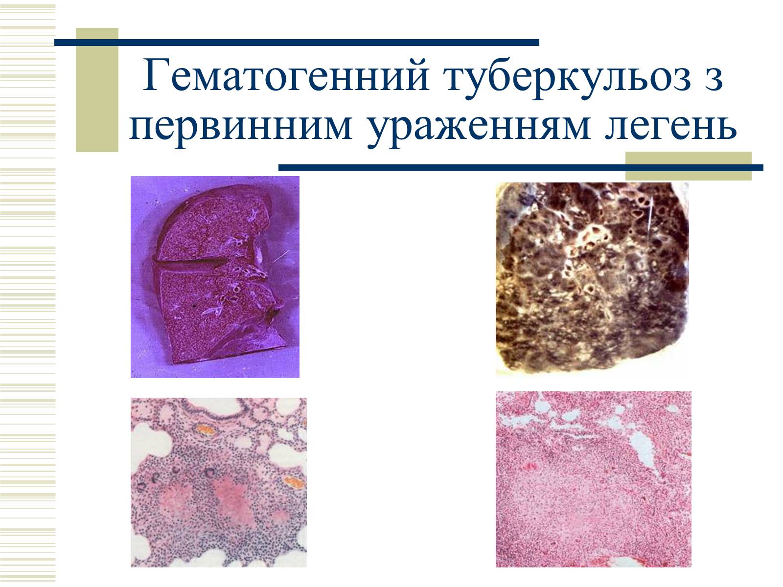 Презентація на тему «Патологічна анатомія туберкульозу» - Слайд #20