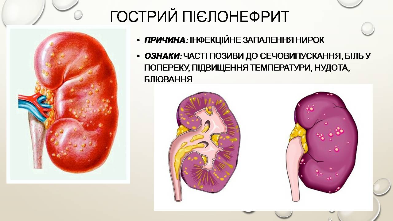 Презентація на тему «Перша допомога при захворюваннях шлунково-кишкового тракту та сечовивідної системи» - Слайд #12