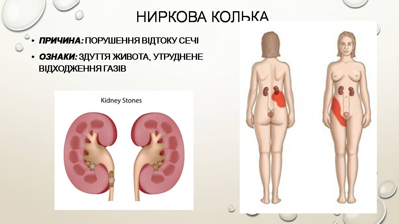 Презентація на тему «Перша допомога при захворюваннях шлунково-кишкового тракту та сечовивідної системи» - Слайд #14