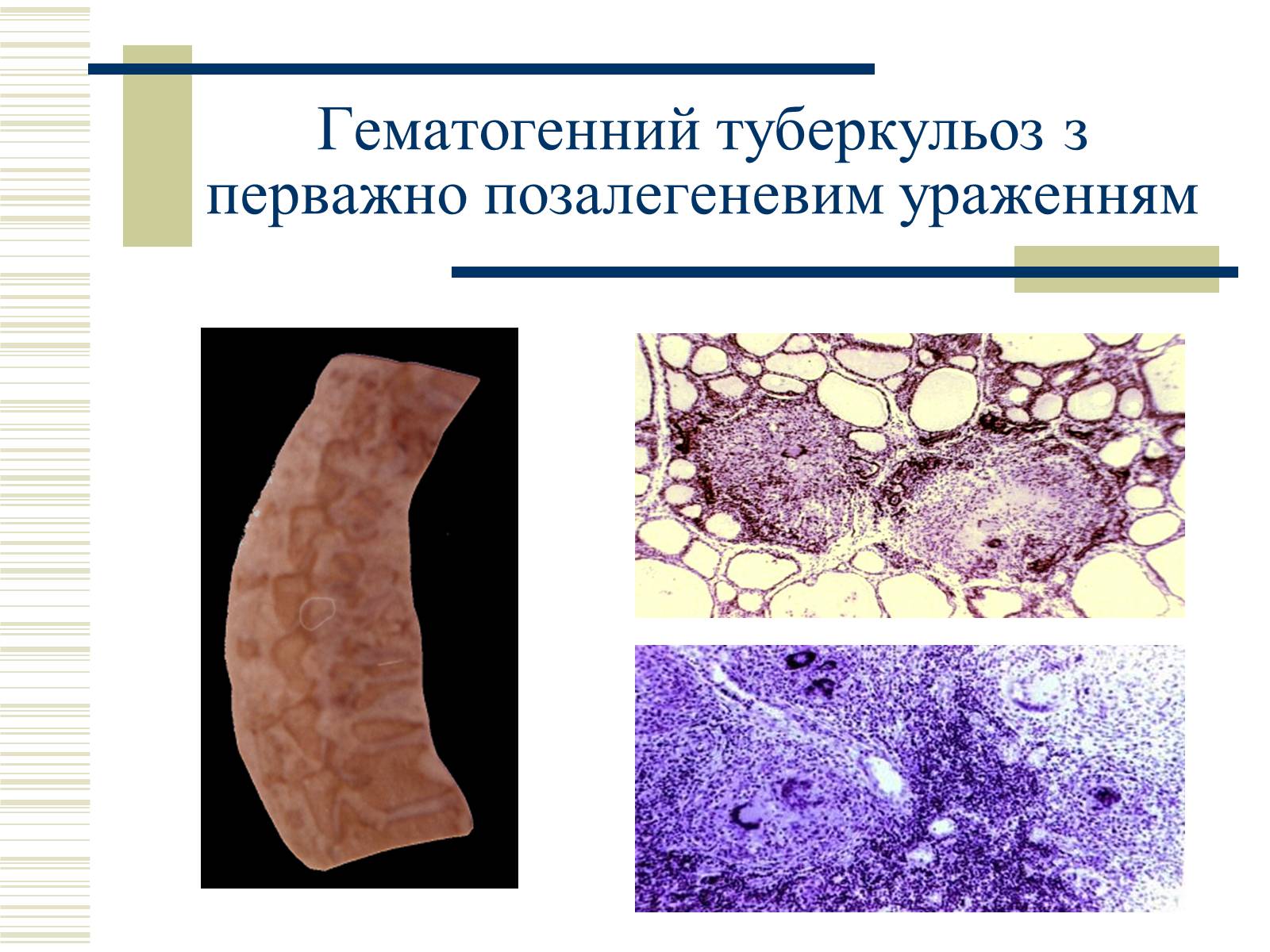 Презентація на тему «Патологічна анатомія туберкульозу» - Слайд #22