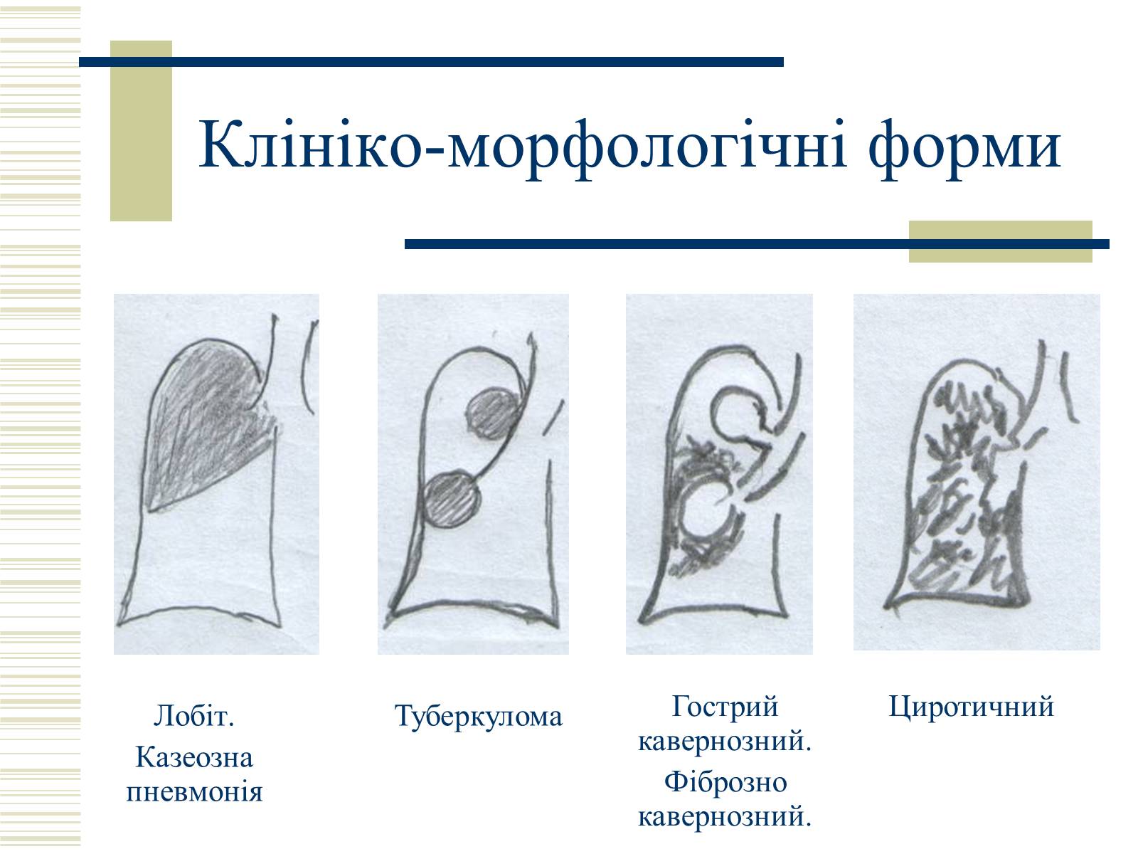 Презентація на тему «Патологічна анатомія туберкульозу» - Слайд #27