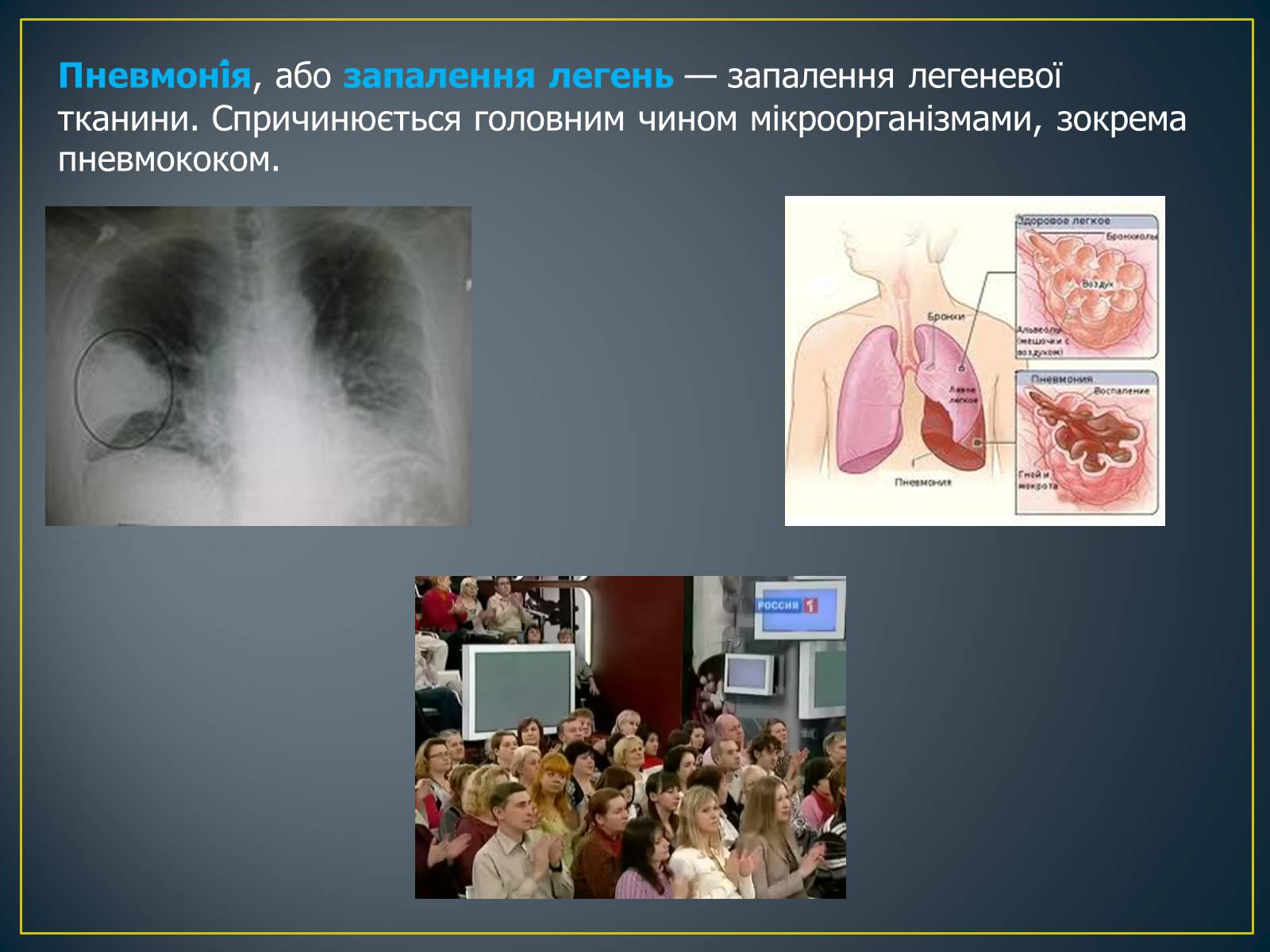 Презентація на тему «Захворювання органів дихання» - Слайд #10