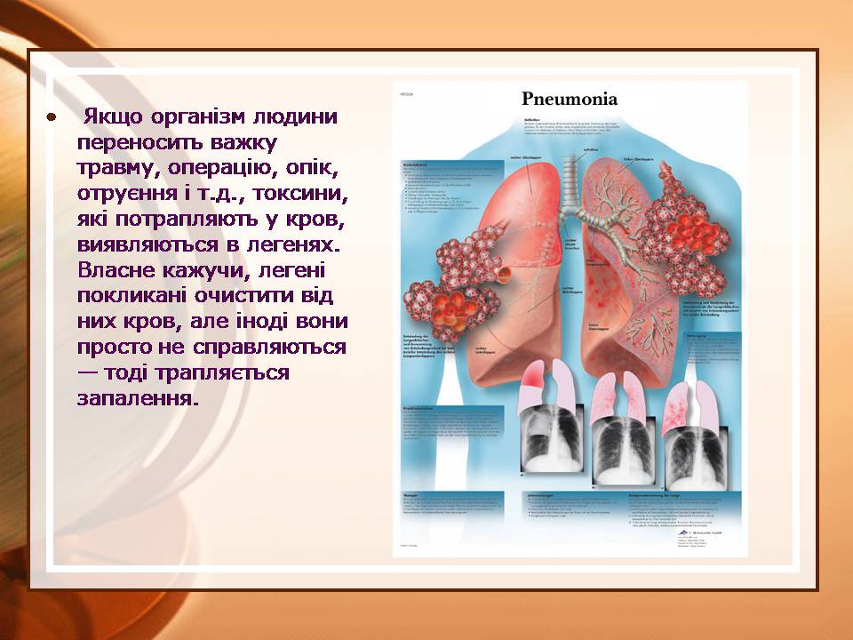 Презентація на тему «Пневмонія» - Слайд #4