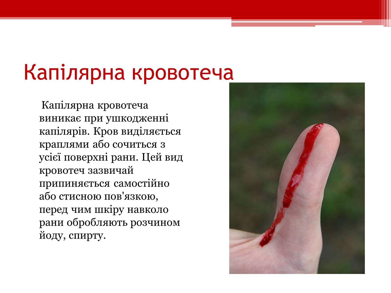 Презентація на тему «Перша допомога при кровотечах» (варіант 1) - Слайд #5