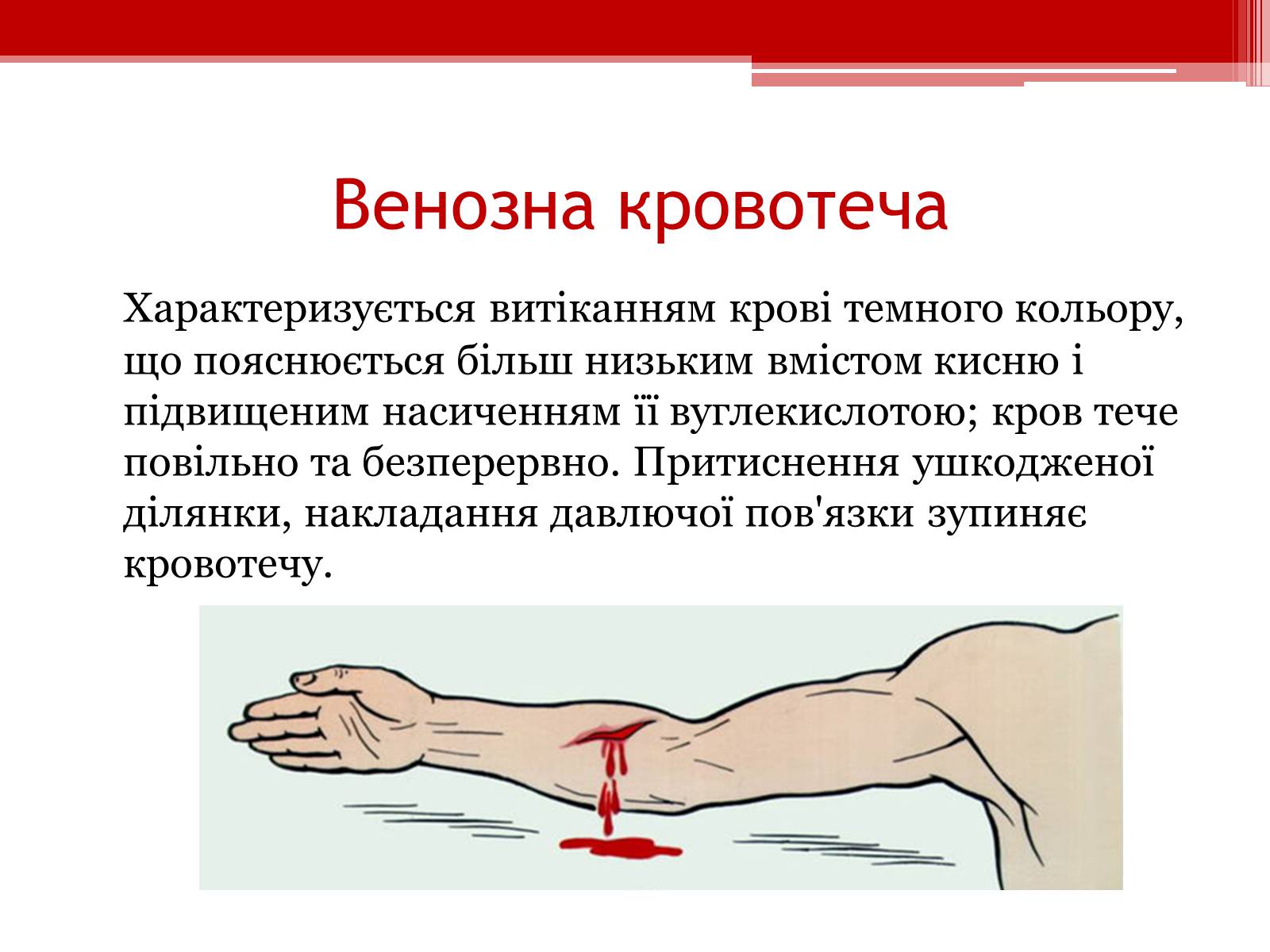 Презентація на тему «Перша допомога при кровотечах» (варіант 1) - Слайд #6