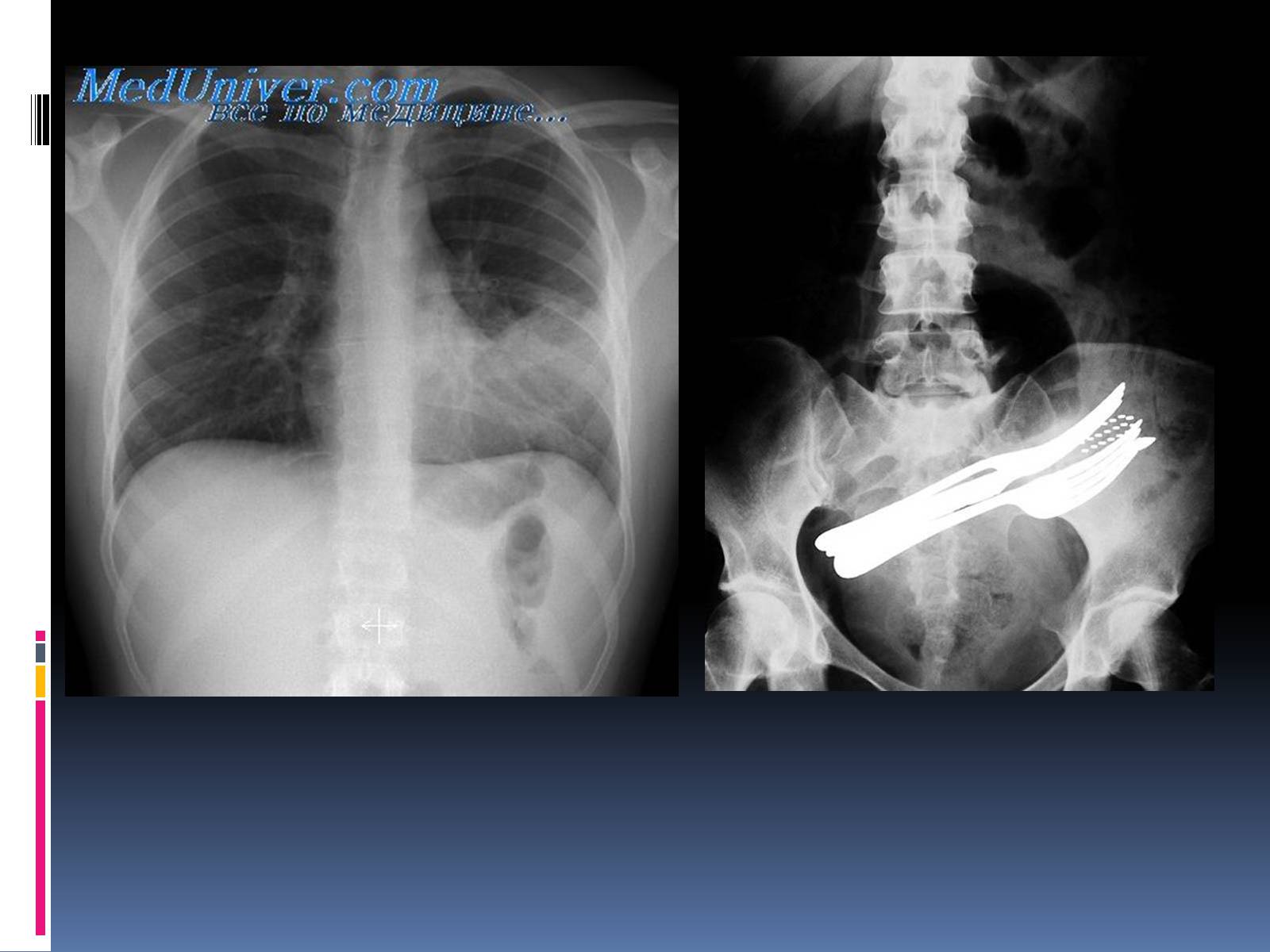 Презентація на тему «Рентгенівське випромінювання» (варіант 1) - Слайд #8