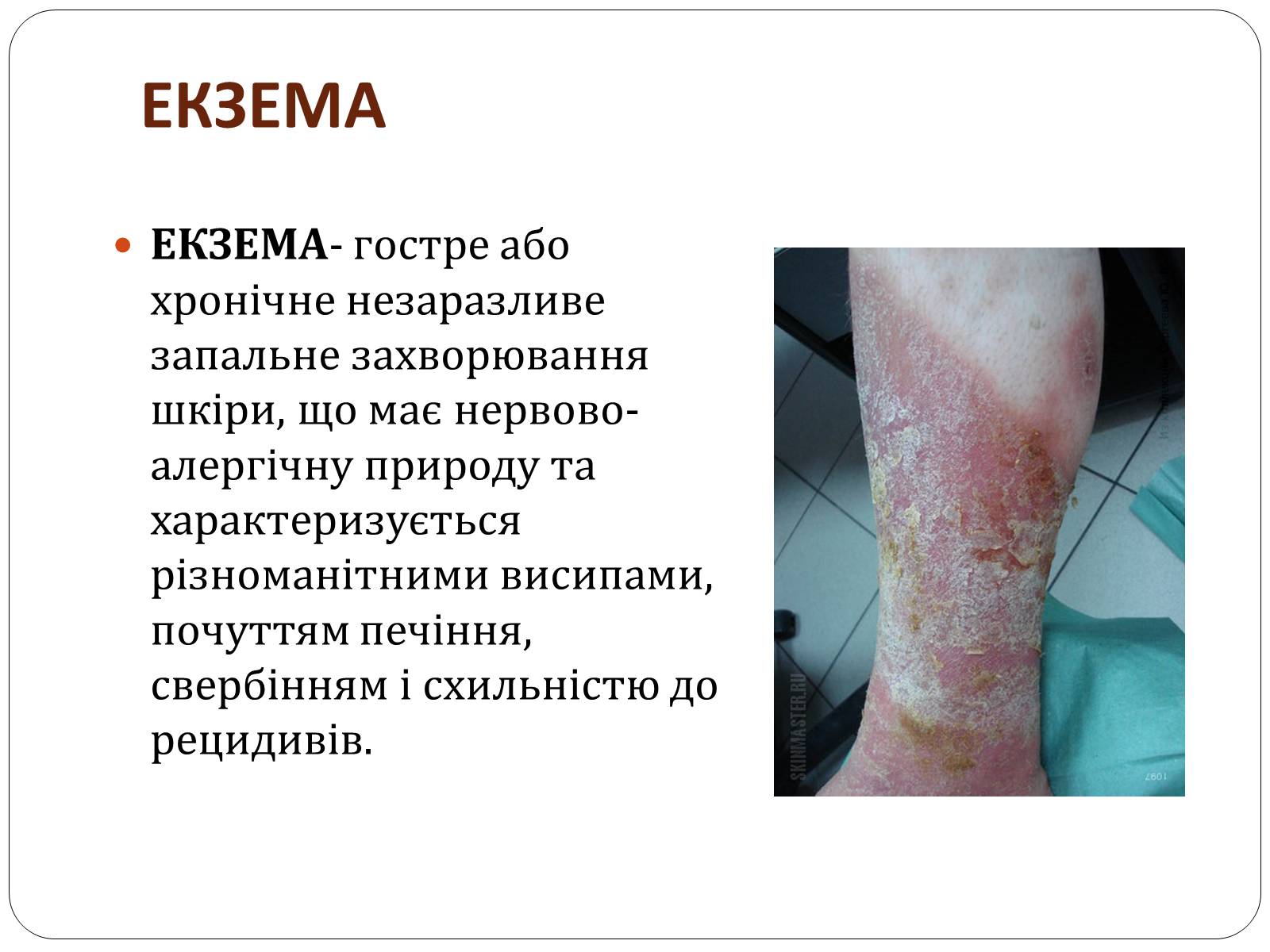 Презентація на тему «Захворювання шкіри» (варіант 3) - Слайд #12