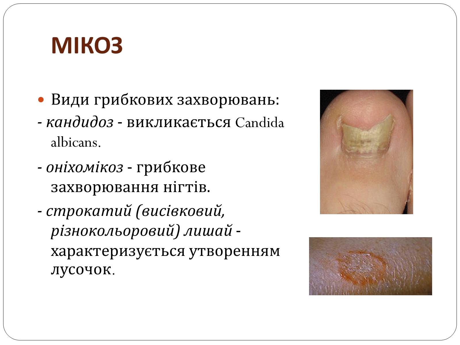 Презентація на тему «Захворювання шкіри» (варіант 3) - Слайд #14