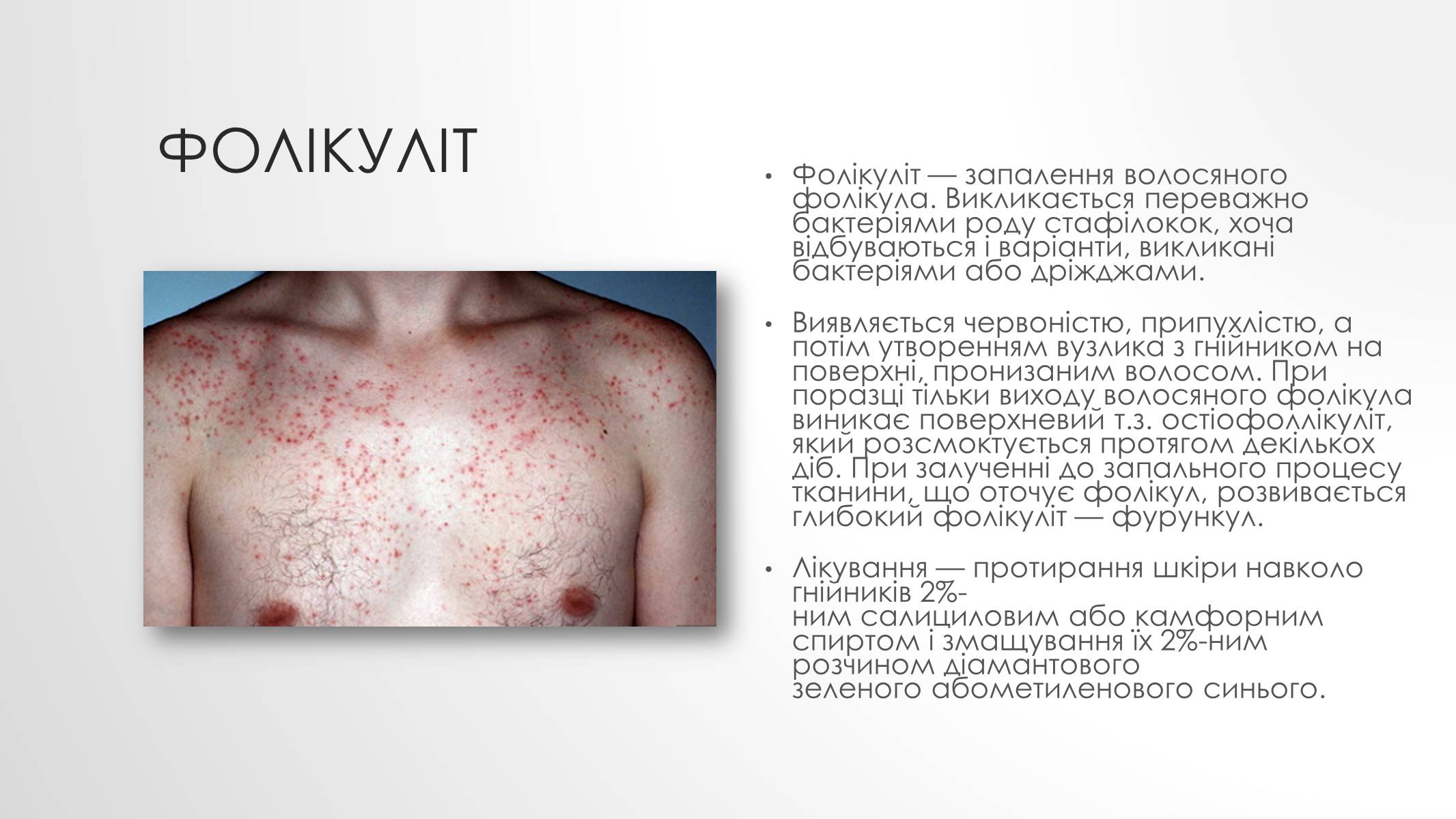 Презентація на тему «Шкірні захворювання» - Слайд #12