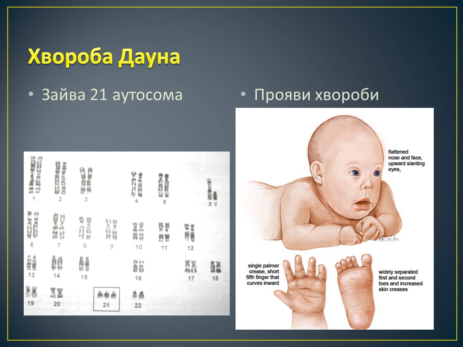 Презентація на тему «Типи генетичних хвороб людини» (варіант 1) - Слайд #13