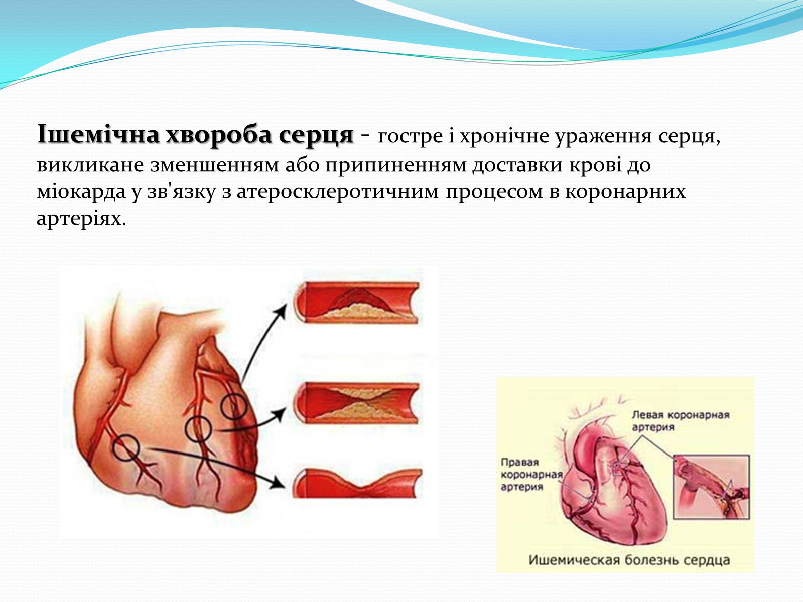 Презентація на тему «Серцево-судинні захворювання» - Слайд #7