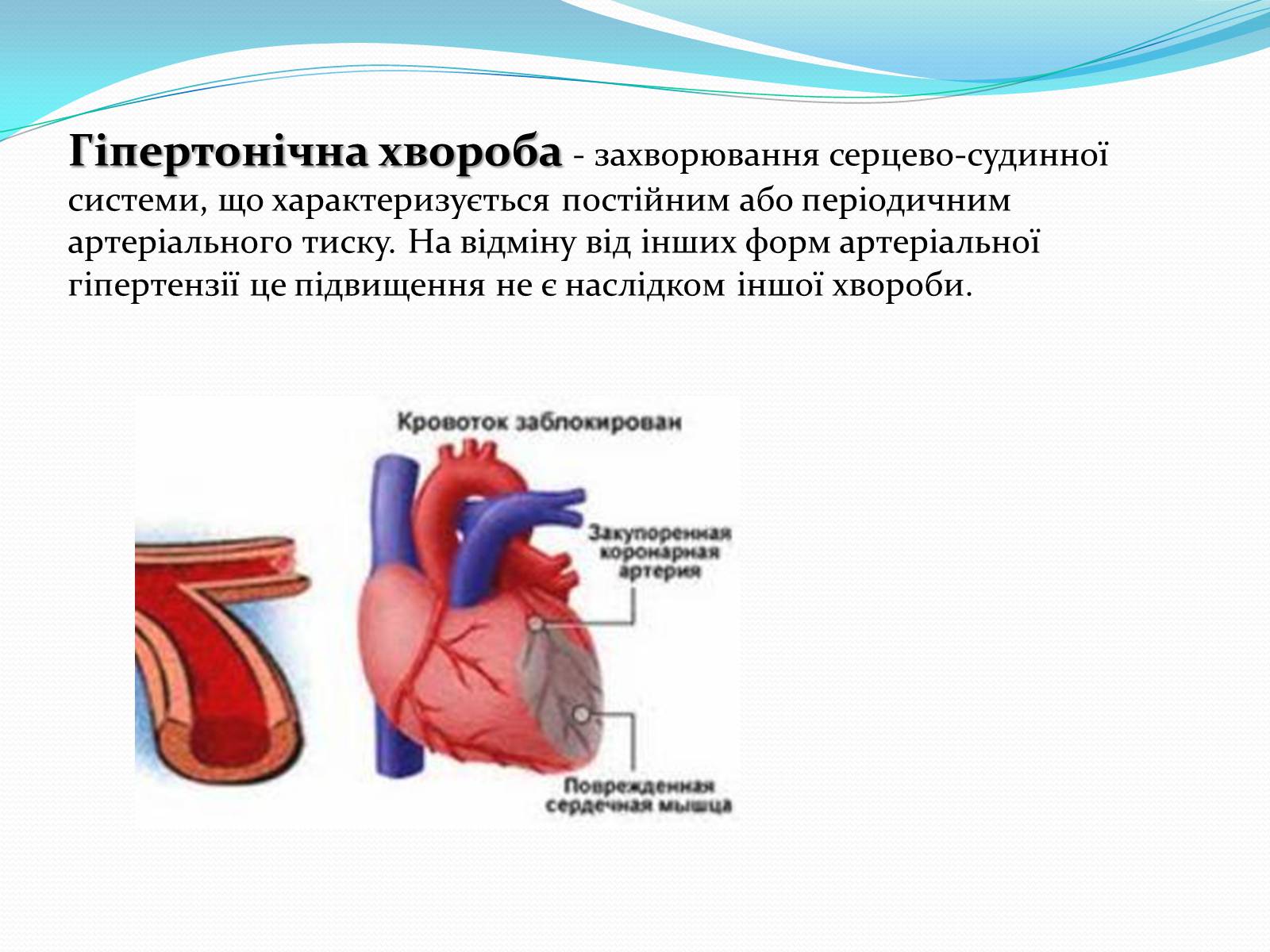 Презентація на тему «Серцево-судинні захворювання» - Слайд #8
