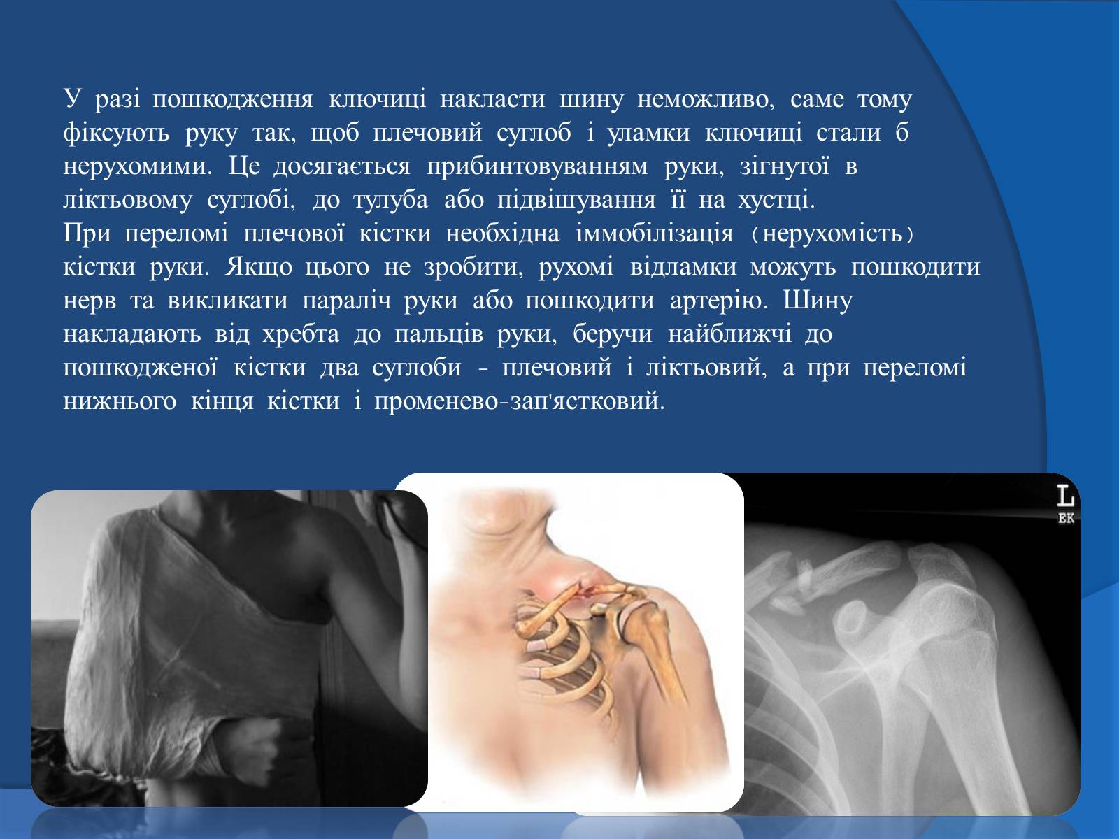 Презентація на тему «Травми кісток та суглобів» - Слайд #12