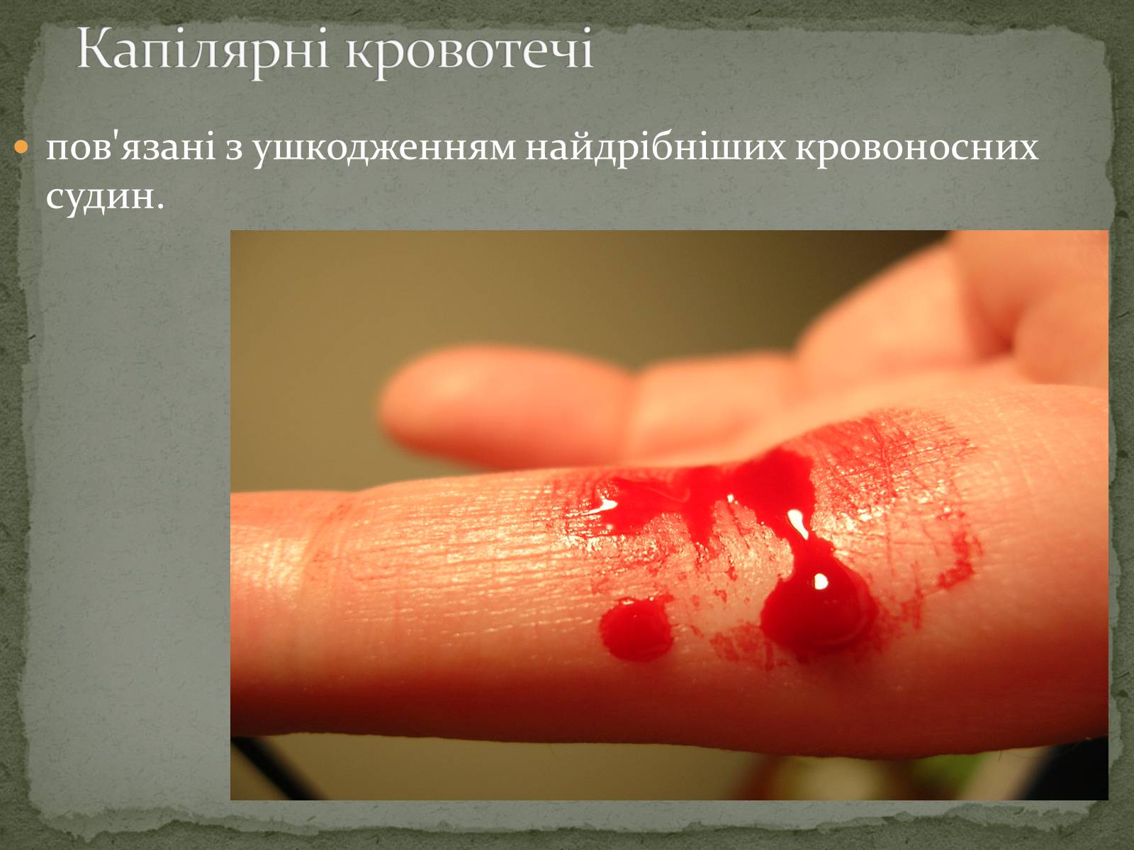 Презентація на тему «Види кровотеч» (варіант 1) - Слайд #9