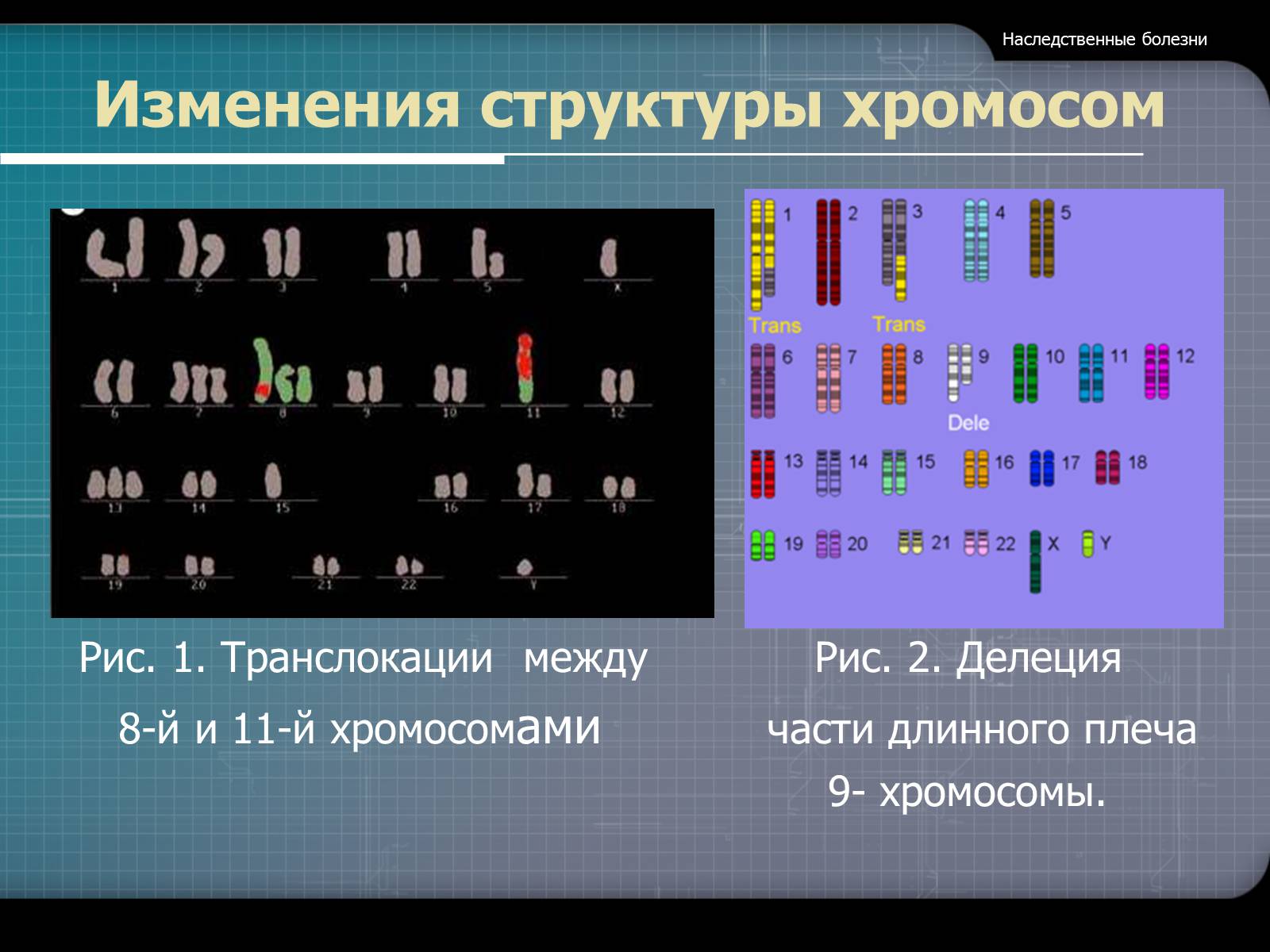 Наследственные заболевания связанные с хромосомами. Структурные изменения хромосом. Изменение структуры хромосом. Изменение структуры хромосом болезни. Измененная структура хромосом.