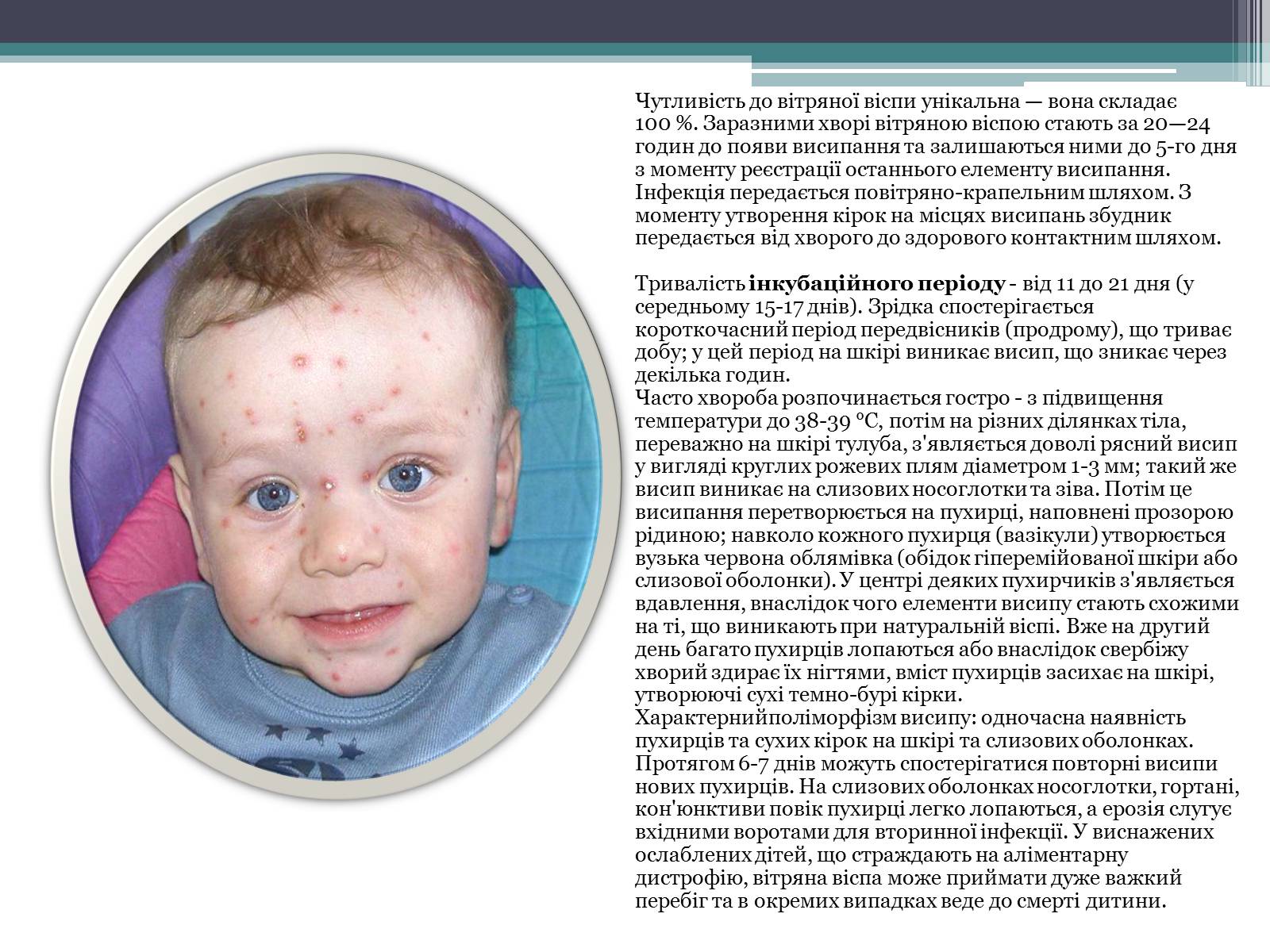 Презентація на тему «Дитячі інфекційні захворювання» - Слайд #16