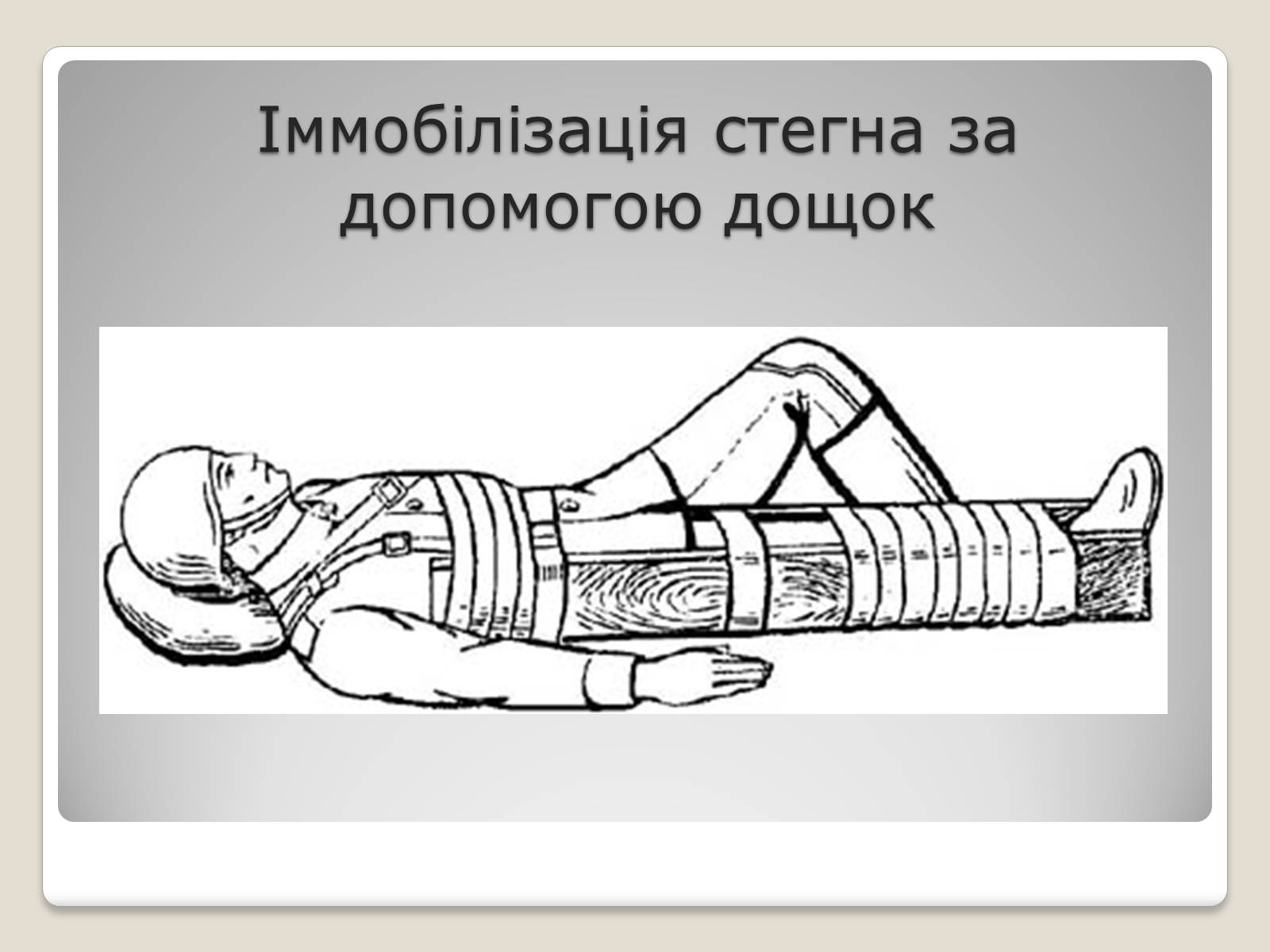 Презентація на тему «Іммобілізація ушкодженої ділянки тіла» - Слайд #4