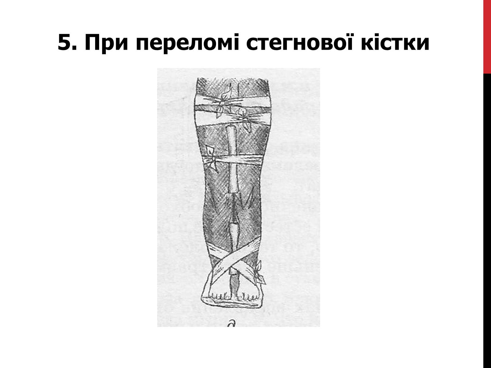 Презентація на тему «Іммобілізація верхніх та нижніх кінцівок» - Слайд #10