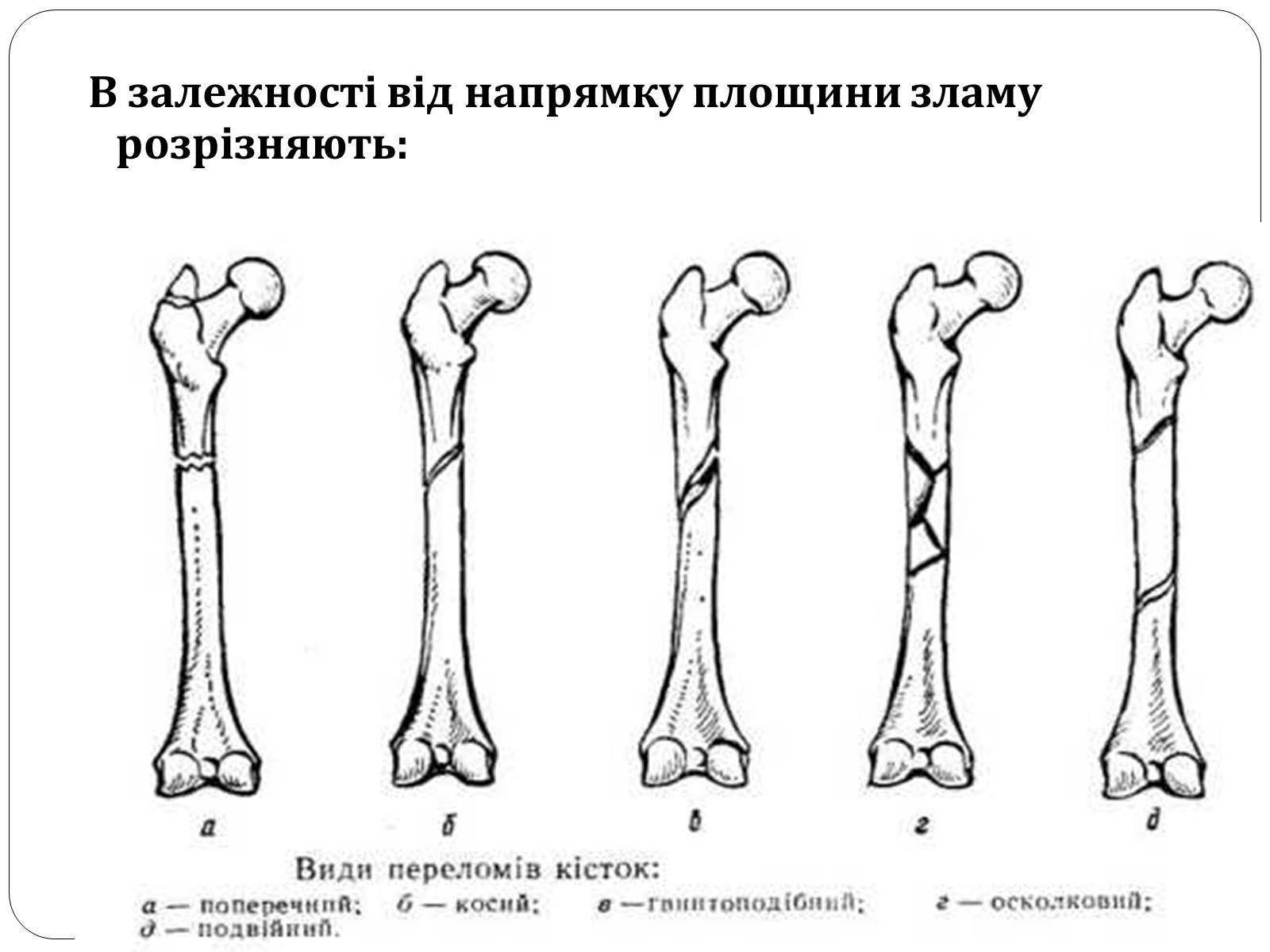 Реферат: Вивихи Переломи кісток