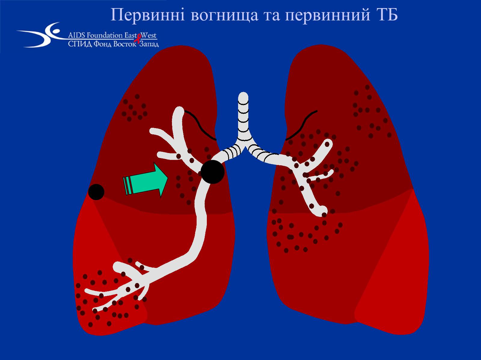 Презентація на тему «Туберкульоз» (варіант 1) - Слайд #22